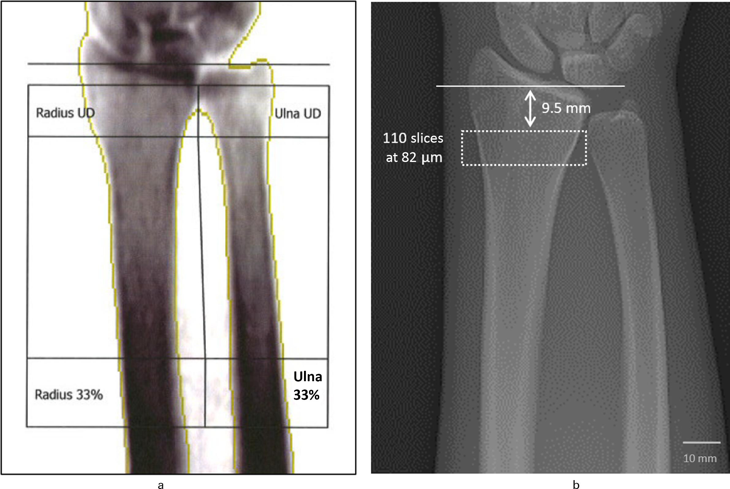 Fig. 1 
            Scanning region at the distal radius for measurement of the quantitative bone mineral density (BMD). a) Dual-energy X-ray absorptiometry (DXA) measuring the areal BMD (aBMD) (g/cm2) of the radius. For the radial aBMD, the ultra-distal region (radius UD) and one-third distal region (radius 33%) were included. b) High-resolution peripheral quantitative CT (HR-pQCT) (resolution of 82 µm) measuring the volumetric BMD (vBMD) (mgHA/cm3) of the radius. The scanning region includes 110 slices with a nominal voxel size of 82 µm starting 9.5 mm from the inflection point of the distal radius endplate.
          