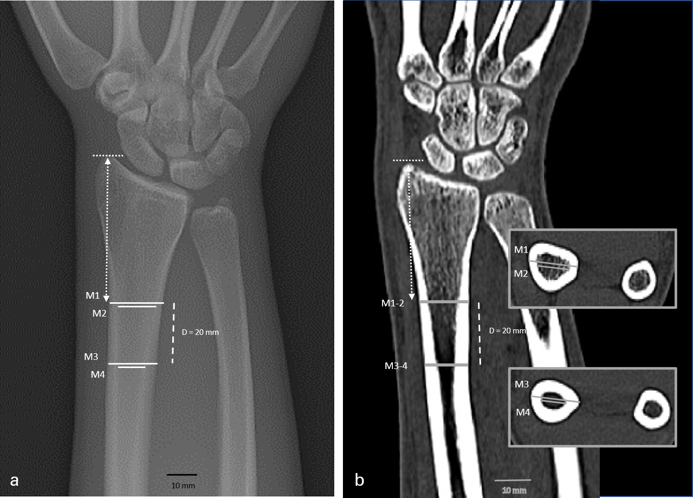 Fig. 2 
            Cortical bone thickness (CBT) measurement in a 46-year-old male: a) standard anteroposterior radiograph (XR) and b) clinical CT in coronal plane. CBT was determined on two levels (M1/M2 and M3/M4) with a distance of 20 mm (dashed line). The identical height in XR and CT was ensured by transferring the length from the styloid to the first level (scattered lines).
          