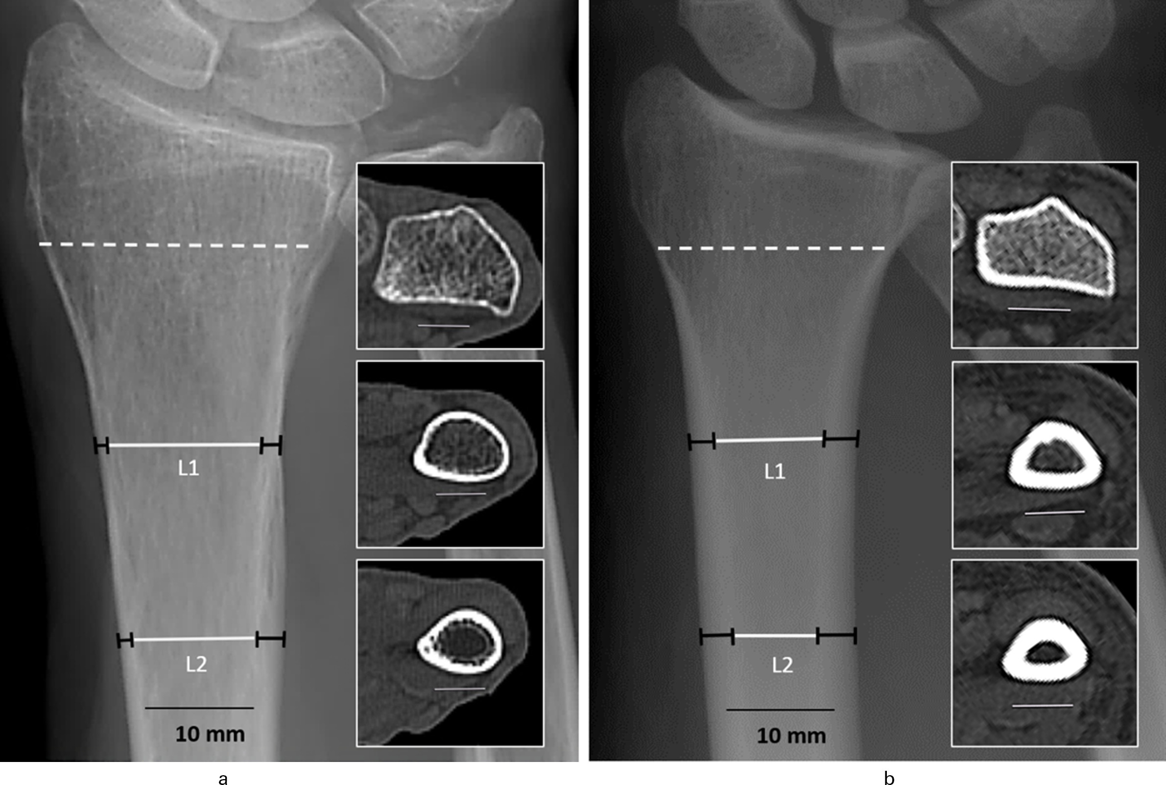Fig. 3 
            Cortical bone thickness (CBT) in standard anteroposterior radiographs of two radius samples with a) low areal bone mineral density (aBMD) (0.37 g/cm2) (female, 89 years old) and b) high aBMD (0.67 g/cm2) (male, 32 years old). Apparent difference in the CBT with a mean average CBT (CBTavg) of 3.95 mm (a) versus 6.65 mm (b). CBT visualized in a high-resolution peripheral quantitative CT (HR-pQCT) (volumetric bone mineral density (vBMD)) section (scattered line/insert) and at the CBT levels (L1 and L2 black bars = cortical thickness) with the corresponding CT sections (inserts).
          