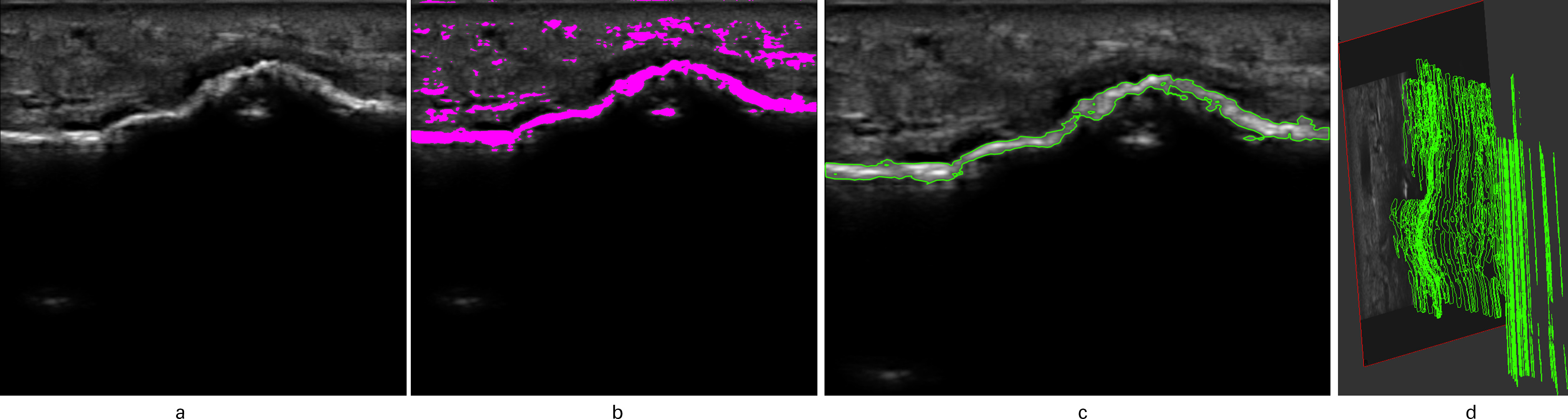 Fig. 1 
            a) Example of semi-automatic ultrasound 3D mapping with callus. a) Long axis scout of tibia. b) Mapping of sonographic callus using the grayscale threshold of 80. c). Plotted sonographic callus. d) Matrix plot of sequential 2D images of sonographic callus and cortical tibia surface.
          