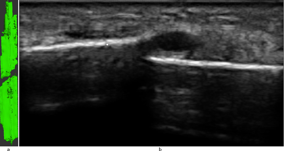 Fig. 2 
            Two-week ultrasound of anteromedial cortex of fracture site without callus (Patient 7). a) 3D reconstruction. b) Long axis scout image.
          
