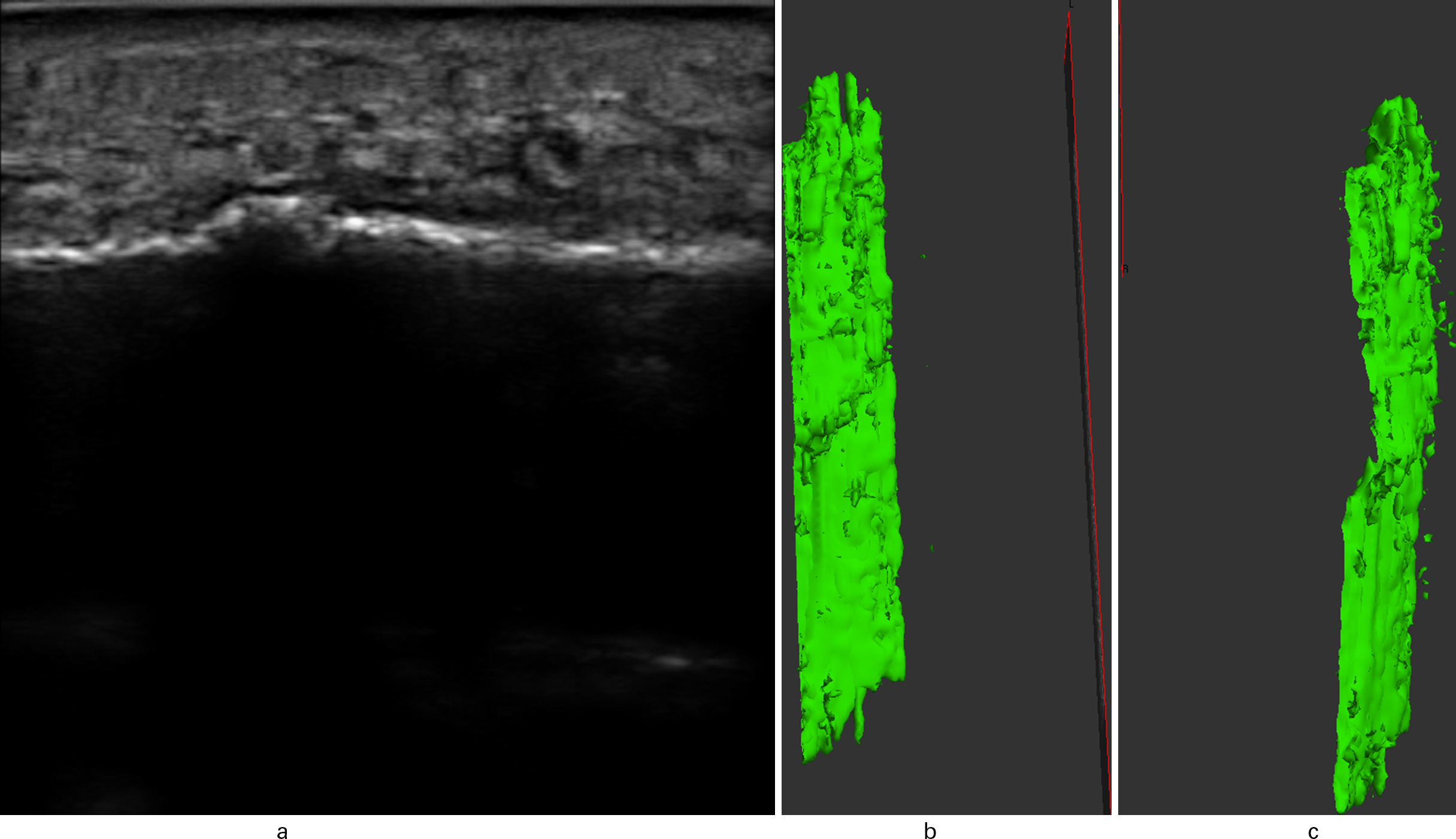 Fig. 3 
            Six-week ultrasound of anteromedial cortex with bridging callus (Patient 7). a) Long axis scout image. b) 3D reconstruction with bridging callus. c) Second view of 3D reconstruction.
          