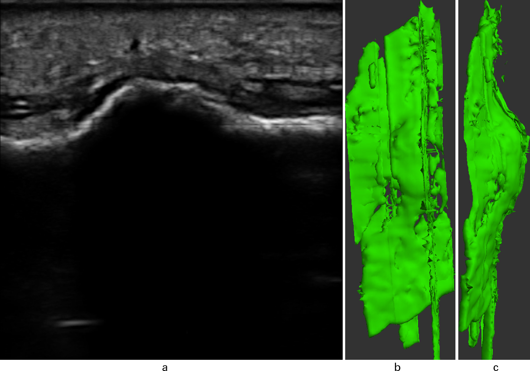 Fig. 4 
            A 12-week ultrasound of anteromedial cortex with remodelling bridging callus (Patient 7). a) Long axis scout image. b) 3D reconstruction with remodelling callus. c) Second view of 3D reconstruction.
          