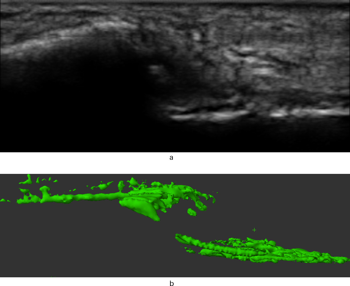 Fig. 5 
            A 12-week ultrasound of anteromedial cortex without sonographic callus (Patient 5). a) Long axis scout image. b) 3D reconstruction with absent bridging callus.
          