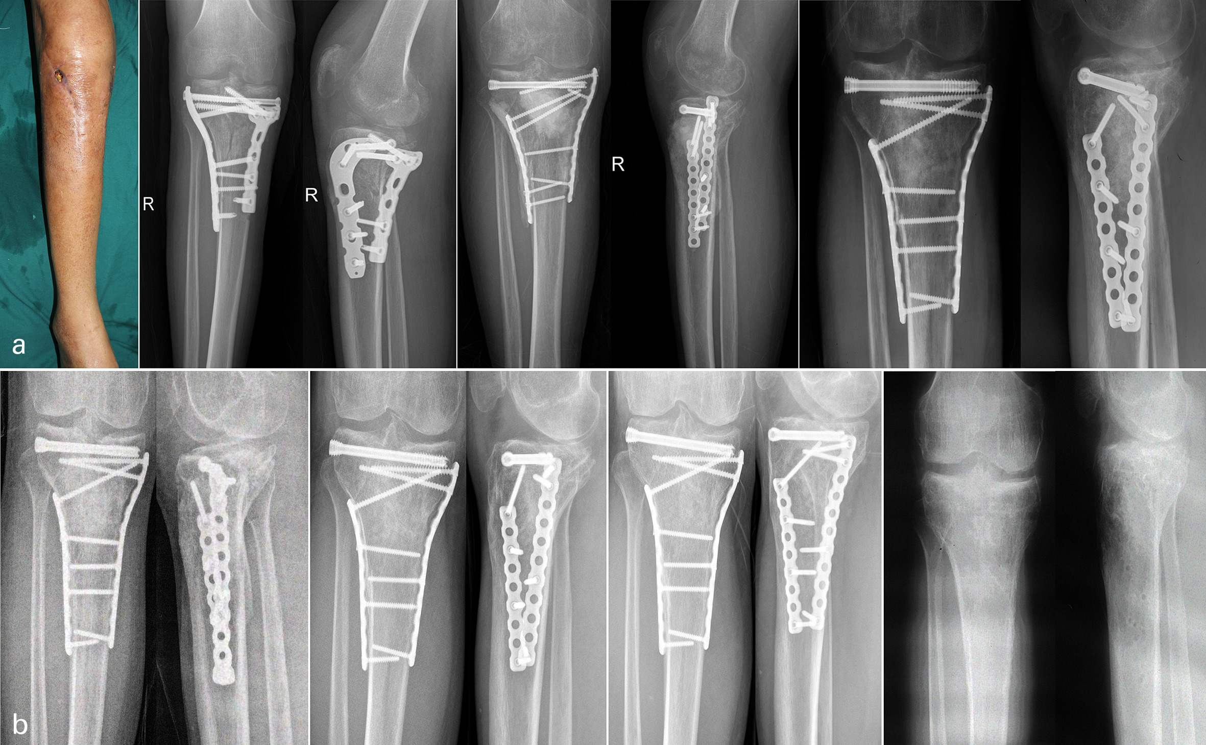 Fig. 2 
          Two-stage treatment process of a 40-year-old male patient with a Schatzker V fracture. a) Anteroposterior (AP) and lateral radiographs before operation. Plate exposure seen prior to operation (photograph). First-stage postoperative AP and lateral radiograph showed that bone defect was filled with antibiotic bone cement spacer, and the locking plate and hollow screw were used as internal fixator to limb stabilization. Second-stage postoperative AP and lateral radiographs demonstrating placement of iliac crest autograft after removal of spacer and replacement of implant to limb stabilization. b) Radiographs of three, 12, 24, and 30 months after bone grafting, where the implants were removed at 30 months, demonstrating the duration of bony consolidation.
        