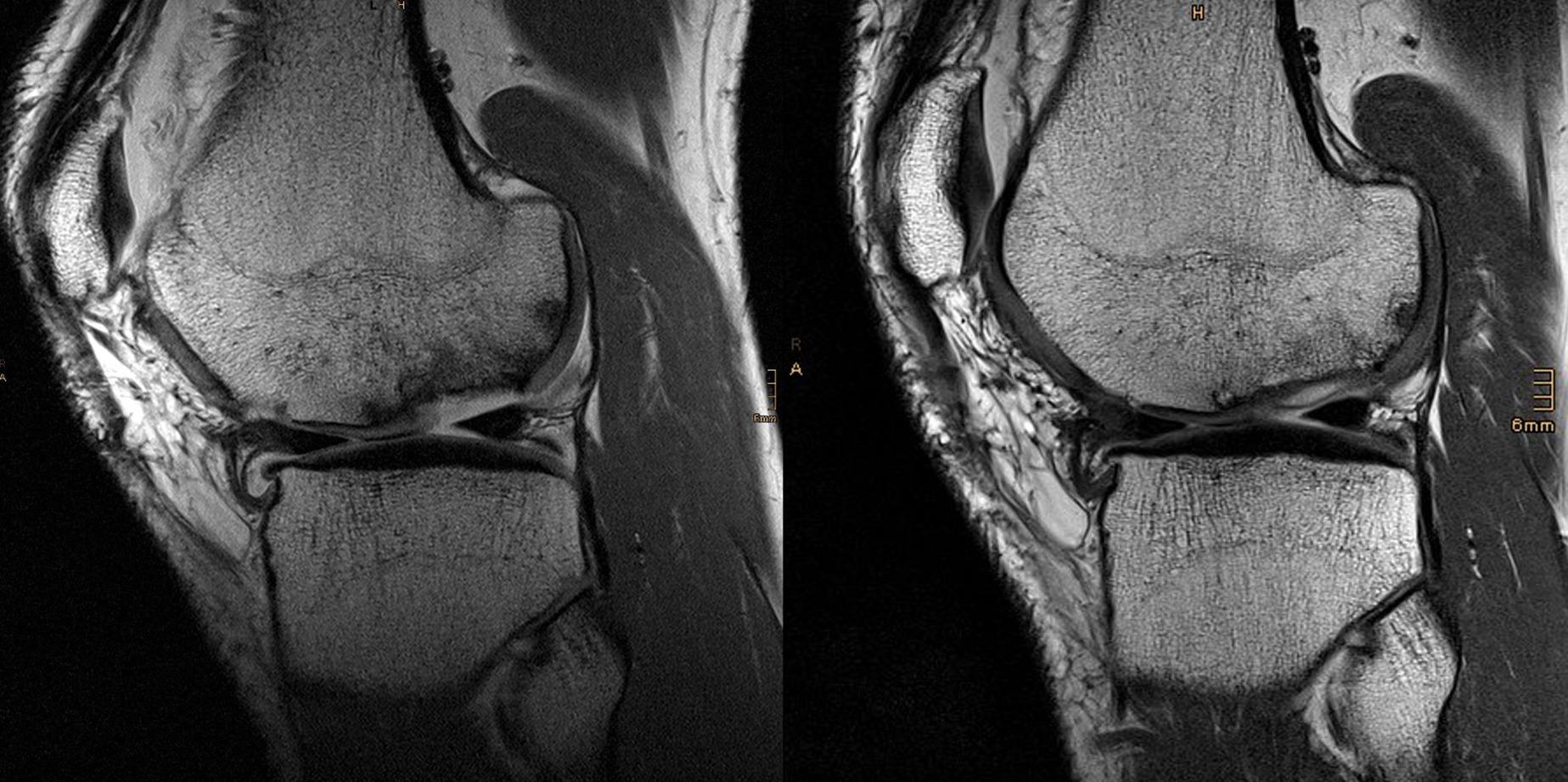 Fig. 4 
          Preoperative and follow-up MRI of a 45-year-old male patient two years after matrix-associated autologous chondrocyte transplantation procedure with the NOVOCART 3D 543 mm × 270 mm (72 × 72 DPI).
        