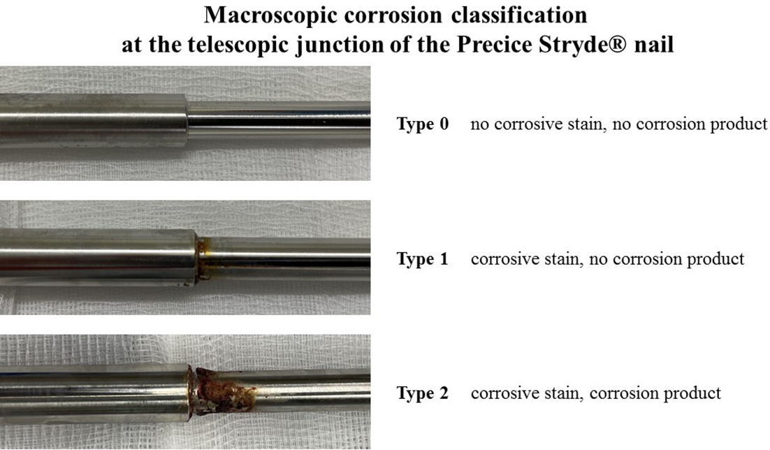 Fig. 1 
            This classification system aims to standardize reporting of corrosion at the junction of the Stryde nail and can be employed immediately after implant removal. It is based on obvious macroscopic features.
          