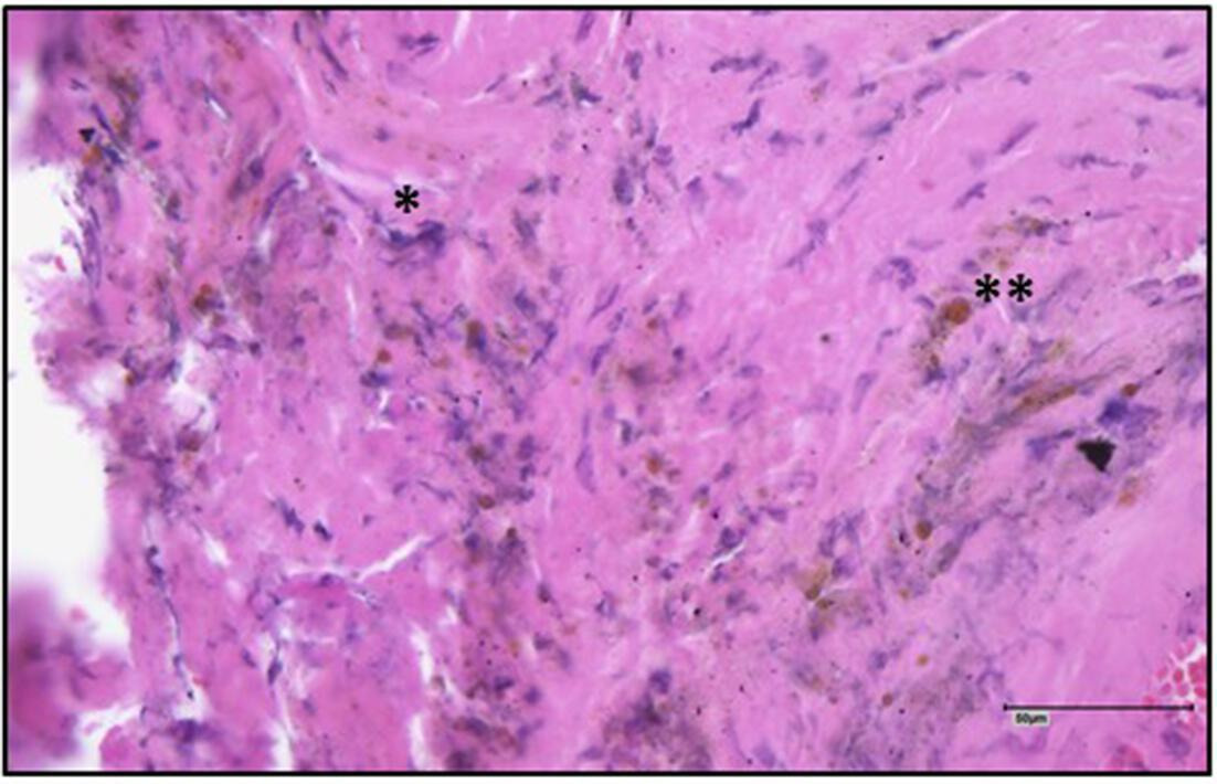 Fig. 10 
            Haematoxylin and eosin stains of intramedullary tissue samples obtained by reaming after removal of a Stryde nail with macroscopic signs of corrosion at the junction and osteolysis of the treated segment (patient no. 39). Infiltrate of macrophages and multinuclear giant cells (*) indicate acute and chronic inflammation (Type 1 synovial-like interface membrane according to the Krenn consensus classification).20 Macrophages containing brown metallic particles were detected (**). Images were taken at a 100× magnification.
          