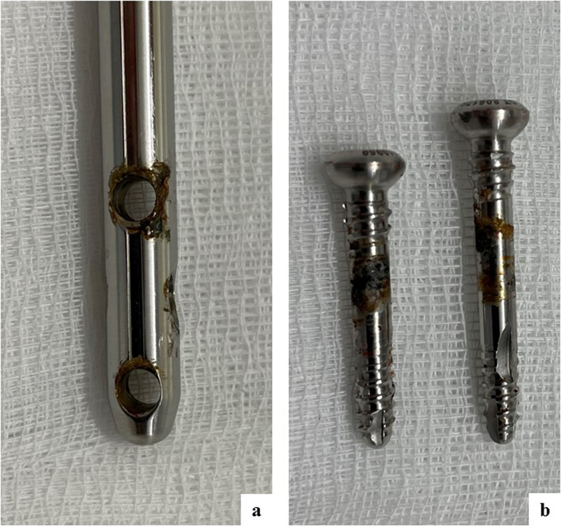 Fig. 3 
            Corrosion of the a) distal locking holes and b) corresponding bolts of patient no. 39. Osteolysis was observed in bi-planar radiographs six months after surgery. The patient reported rest and ambulation pain during the consolidation period.
          