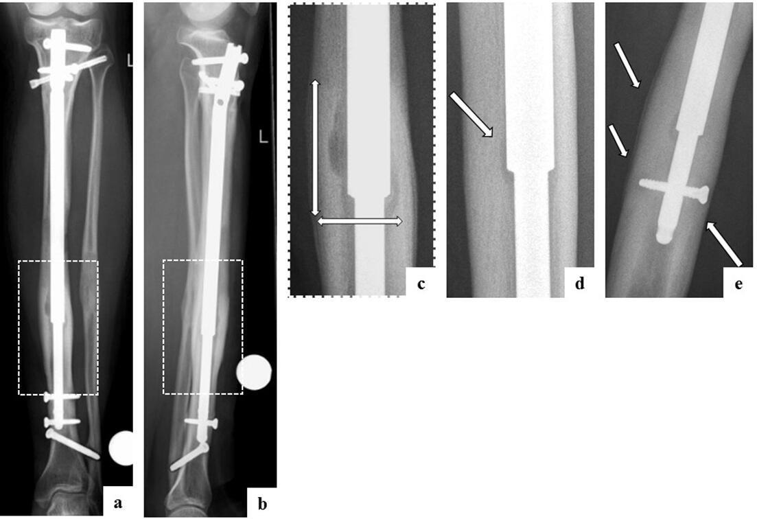 Fig. 4 
            a) Anteroposterior (AP) and b) lateral radiographs of the left tibia of patient no. 3 (female 16 years, postoperative at 11 months), who presented with pain and new lytic-hypertrophic osteolysis adjacent to the telescopic junction of the Stryde nail nine months after the end of distraction. c) Close-up of the geographical osteolysis on an AP radiograph with calibrated measurement of 30 mm × 17 mm and thickening of the cortical bone. d) and e) AP radiographs of different cortical reactions: d) lytic only (patient no. 20, male, 16 years, postoperative at 18 months) and e) periosteal reaction and thickening distally level with the locking bolts (patient no. 6, male, 18 years, postoperative at nine months).
          