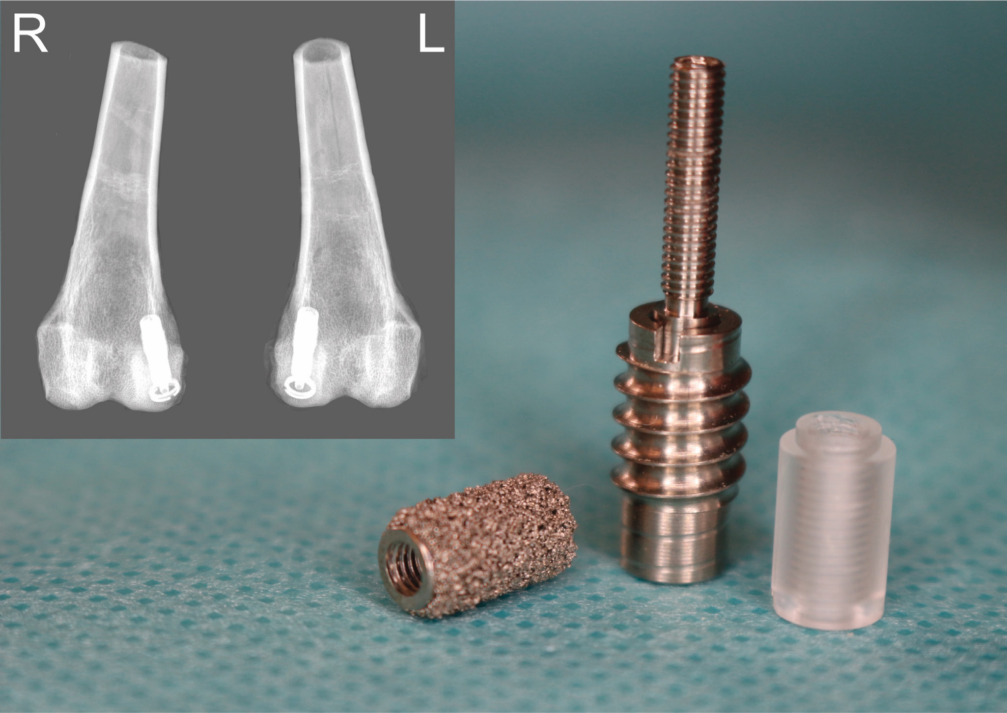 Fig. 1 
            Micromotion device (centre) with a titanium implant (left) and a poly(methyl methacrylate) (PMMA) implant (right).The micromotion device consists of a self-tapping anchor house (bottom) to secure device position in the subchondral cancellous bone of the medial femur condyle (radiograph upper left). A threaded rod on top of a coil spring sits inside the anchor house body, allowing for axial rod movement relative to the anchor-house (top). The coil spring returns the threaded rod to its original position after its compression during stand and gait. The primary PMMA implant has a 500 µm-high receded rim at its base, enabling it to slide a mean 500 µm (standard deviation (SD) 15 µm) inside the anchor house when axially compressed producing an unstable condition. The revision titanium implant has stable conditions by being seated directly on top of the anchor house, preventing the rod from moving axially.
          