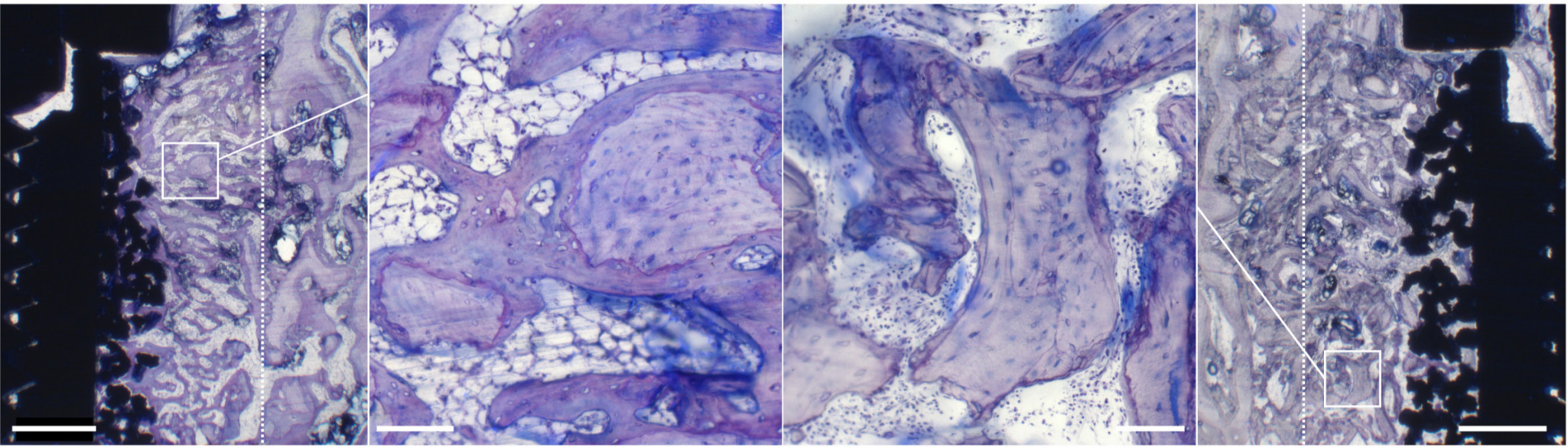 Fig. 3 
            Representative histological sections of the zoledronate-treated groups (toluidine blue). Systemic zoledronate (SZ) group (far left; ×1.25) and local zoledronate (LZ) group (far right; ×1.25). Solid white frames in SZ (×1.25) and LZ (×1.25) mark the positions of the two central images (×10). Bar (×1.25/×10) = 1.0/0.1 mm. Sections are cut longitudinally to the long axis of the implant. Dotted line marks original drill-border. Allograft appears as a lightly stained lamellar structure with empty fusiform lacunae. Lamellar bone appears as allograft having fusiform lacunae with cells. New bone presents as a disorganized, dark-stained structure having round lacunae with cells. SZ (×1.25): extensive remodelling has occurred, with a few small pieces of allograft in the peri-implant gap being covered with new bone, which exhibits high interconnectivity in the peri-implant gap and into the porous surface coating. SZ (×10): allograft with a thick layer of new bone and few resorption lacunae. The surface of the remaining allograft is covered with resorption lacunae, giving it a serrated appearance. LZ (×1.25): large pieces of allograft with thin layers of new bone displaying low interconnectivity in the peri-implant gap and into the porous implant surface. LZ (×10): allograft with ragged and intact edges, non-circumferential new bone coverage, and extensive number of resorption lacunae.
          