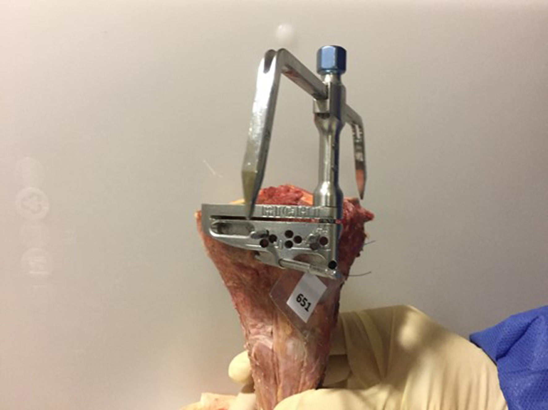 Fig. 2 
            Tibial cutting block set with pins at + 4 mm to achieve a tibial proximal metaphysis cut at a depth of 6 mm, measured from the articular bone surface of the medial tibial plateau.
          