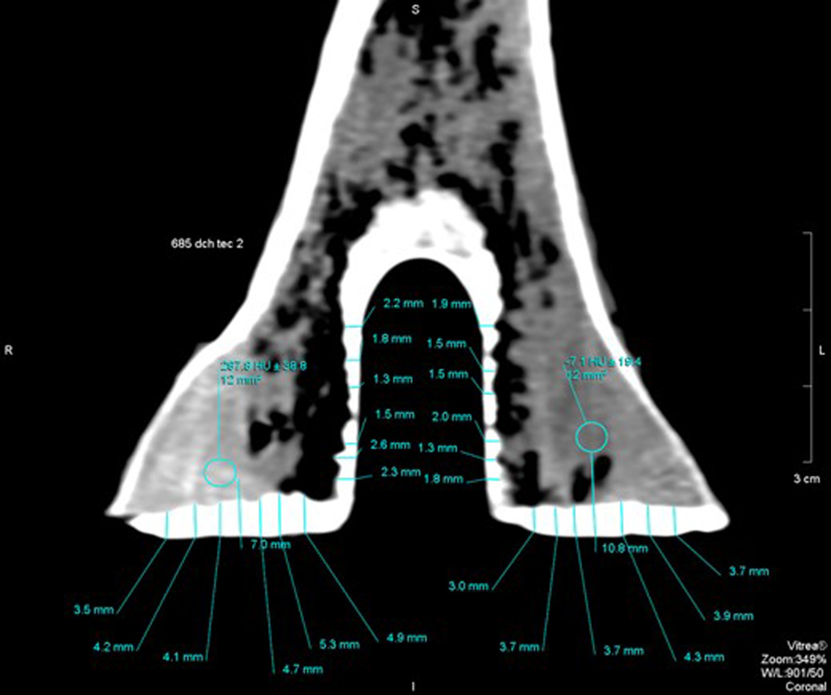 Fig. 3 
            Central coronal CT slide of one of the studied samples. Measurement of the thickness of both the superficial and the metaphyseal cement-bone interfaces.
          