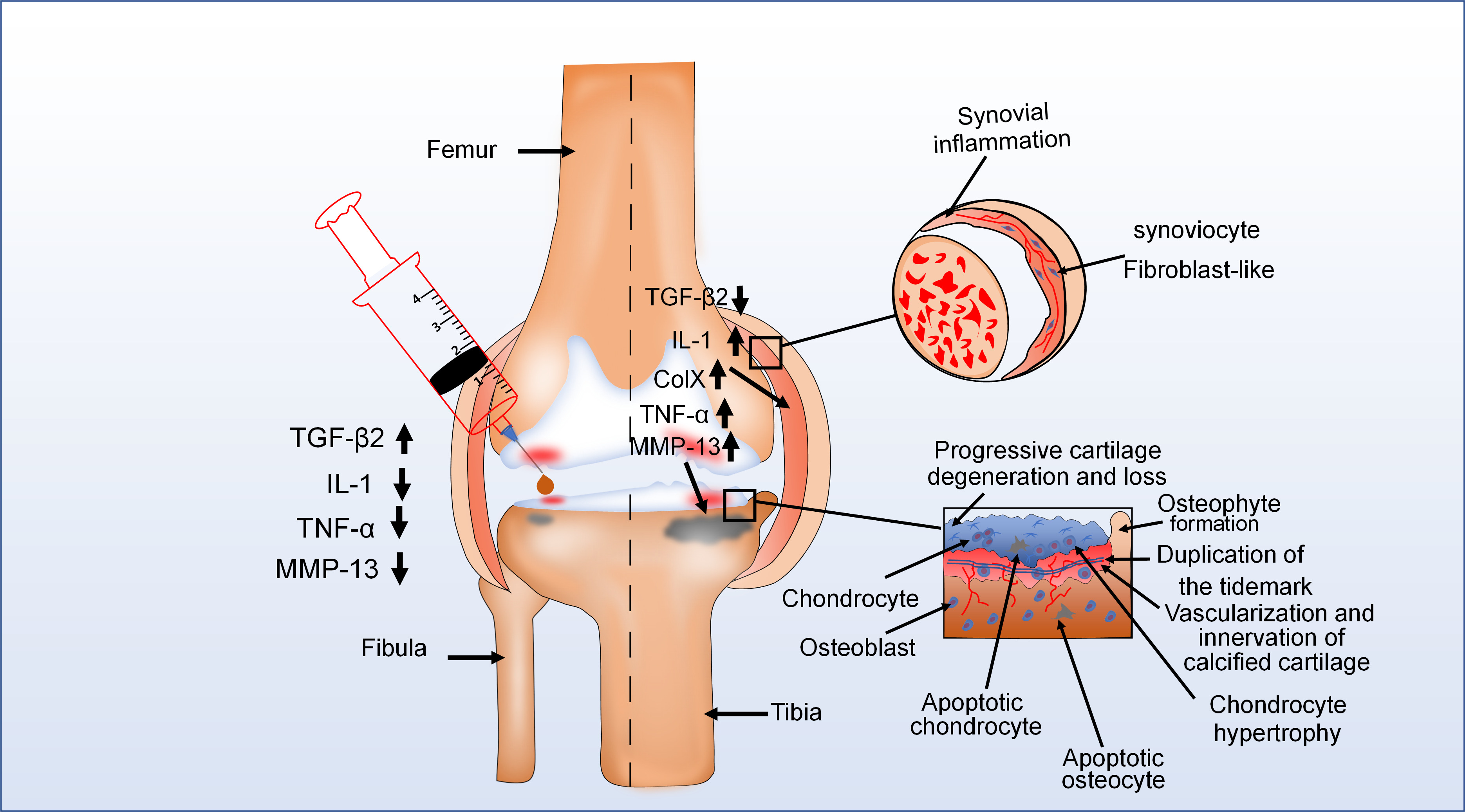 Fig. 4 
            The pathological change of knee joint in the osteochondral unit during the evolution of osteoarthritis (OA). OA is typically characterized by cartilage damage, osteophyte formation, and thickening of the joint capsule. For example, in one diagram (upper right), the epithelial lining of the joint capsule is thickened because of synovial inflammation. In another (bottom right), during advanced stages of OA, there are pathological changes in different areas of articular cartilage. Moreover, in the left diagram, injection of transforming growth factor-beta 2 (TGF-β2) into the joint cavity of patients with OA reduced the expression of some proinflammatory factors and the clinical symptoms of OA. This means that TGF-β2 plays an important role in the development of OA. ColX, collagen type X; IL-1, interleukin 1; MMP, matrix metalloproteinase; TNF-α, tumour necrosis factor alpha.
          