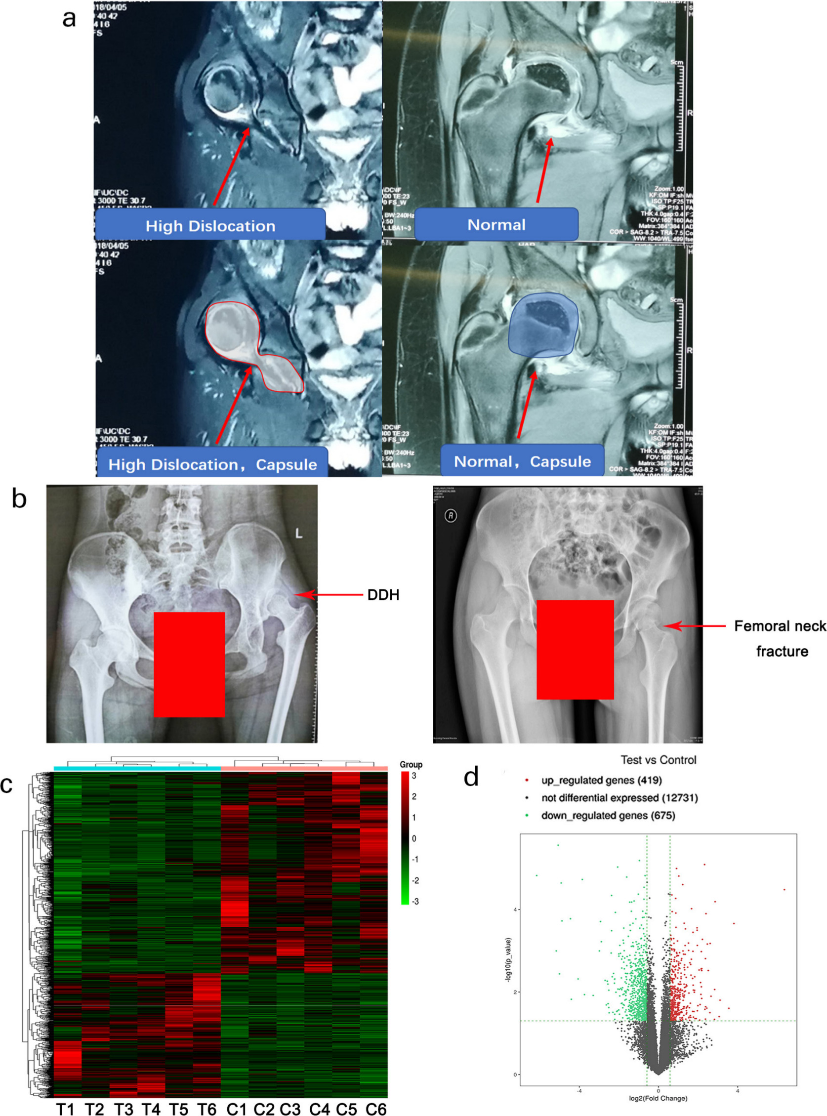 Fig. 1 
            High-throughput sequencing assay reveals genes differentially expressed in hip joint capsules between healthy control and developmental dysplasia of the hip (DDH). Tissues from the hip joint capsule of patients with DDH (n = 6) and healthy controls (n = 6) were used for the high-throughput sequencing assay. Control subjects are enrolled from patients with femoral neck fracture. Despite the femoral neck fracture, the controls had no symptoms or history of congenital dislocation of the hip and other diseases. a) Nuclear magnetic resonance and b) radiograph detection were used for the diagnosis of DDH. c) Gene expression levels are shown in a heat map, in which each row represents a gene and each column represents a sample of hip joint capsule tissue. The variation in colour from red to green represents the signal level, with red indicating high signal or upregulation, green indicating low signal or downregulation, and black representing unchanged expression. T: Test group in which the samples were obtained from patients with DDH; C: Control group in which the samples were obtained from healthy controls. d) Scatter plot showing the distribution of differentially expressed genes between healthy controls and patients with DDH. The x and y axes represent log2 (fold change) and -log10 (p-value), respectively. Red dots indicate upregulated genes and green dots indicate downregulated genes. Gray dots represent genes with no difference in expression. The dashed line defines the up- and downregulation boundaries (p < 0.05 and log2 (fold changes) > 1 or log2 (fold changes) < -1).
          
