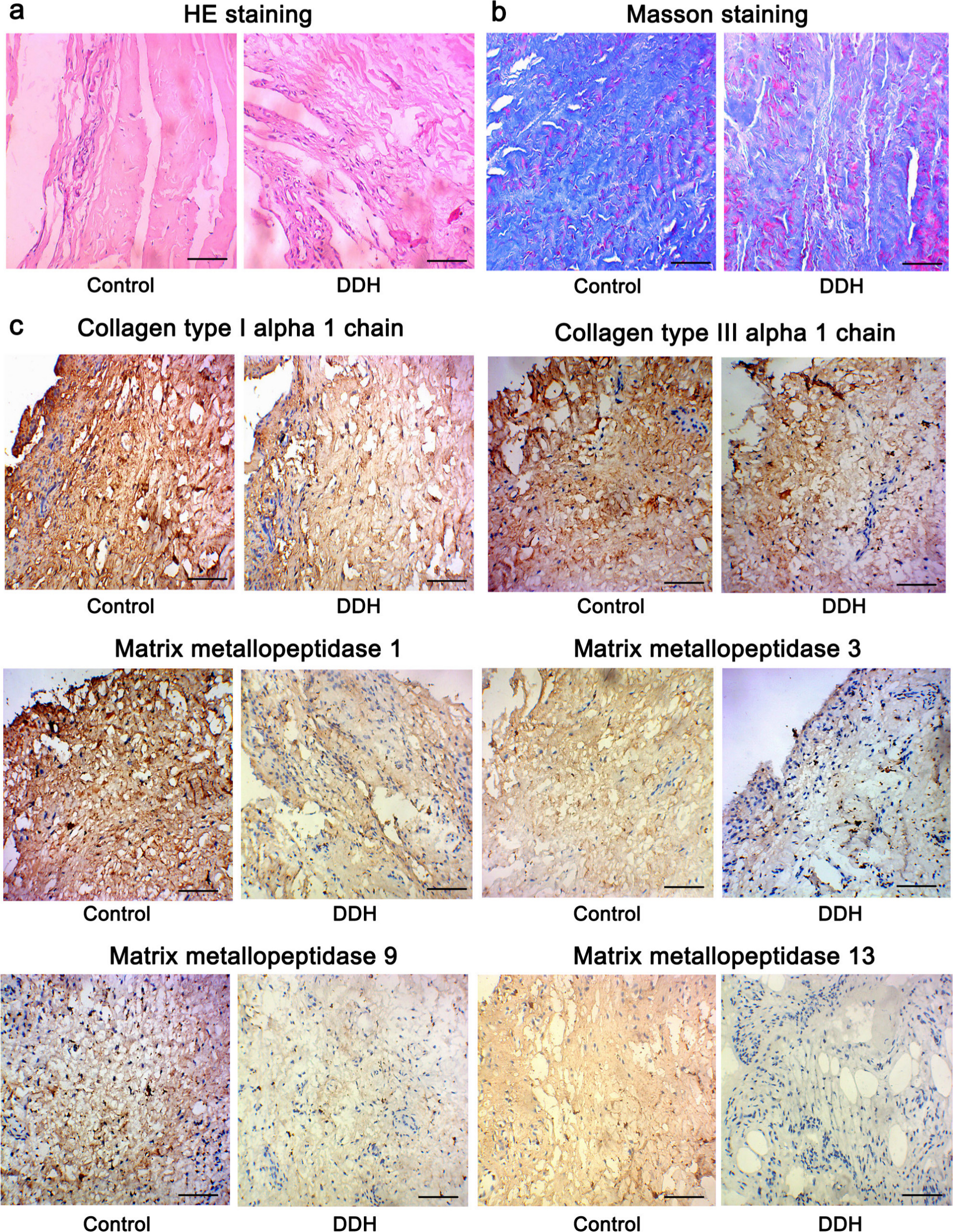 Fig. 2 
            Histological examinations using haematoxylin and eosin (HE), Masson’s, and immunohistochemistry staining (200×). Tissues from the hip joint capsule from patients with developmental dysplasia of the hip (DDH) and healthy controls were subjected to a) HE, b) Masson’s, and c) immunohistochemistry staining. Bar: 10 μm.
          
