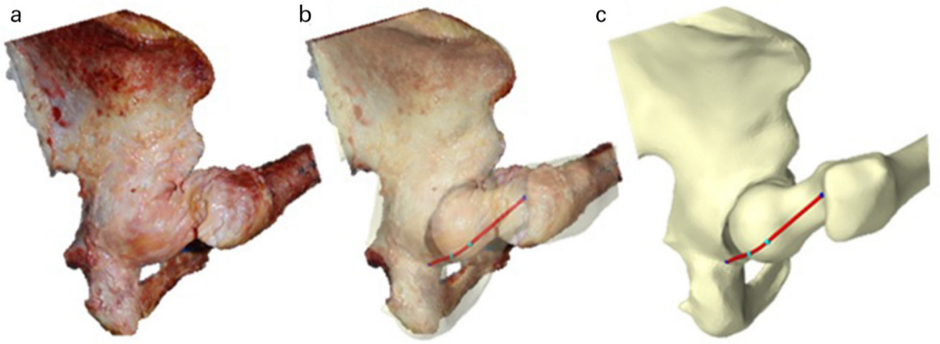 Fig. 1 
            Posterolateral view of a right hip in 90° flexion with adduction and internal rotation (FADIR). a) Photograph showing ischiofemoral ligament fibres taut and wrapped around the femoral head. b) The dominant ischiofemoral ligament line-of-action emphasized by overlapping images (a and c). c) Hip model showing dominant ischiofemoral ligament line-of-action (red) with contact points (blue) wrapping around the femoral head.
          