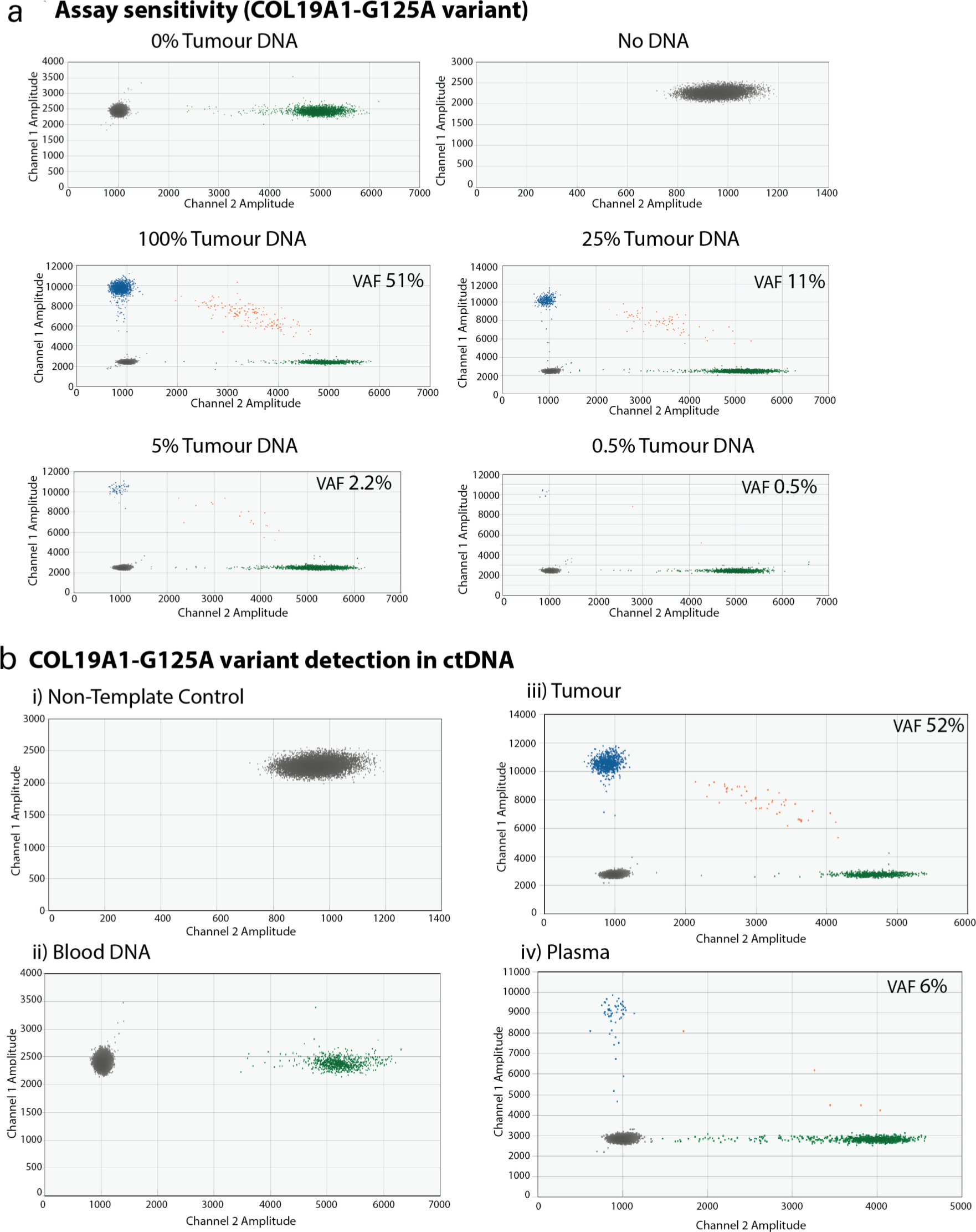 Fig. 3 
            Detection of tumour-specific alterations in sarcoma. Results for a representative case of localized extremity undifferentiated pleomorphic sarcoma. Whole exome sequencing of the primary tumour revealed a COL19A1-G125A variant. a) Results of a dilutional assay, demonstrating our ability to detect this tumour-specific variant at 0.5% of the wild type genome with droplet polymerase chain reaction (ddPCR). b) Results demonstrating that the COL19A1-G125A variant was detectable in the patient’s plasma. Shown are ddPCR results for DNA extracted from the patient’s 1) a non-template control, 2) whole blood (i.e. wild-type; 20 ng DNA), 3) tumour (10 ng DNA), and 4) plasma (i.e. circulating tumour DNA; 10 ng DNA). Green = wild-type-positive droplets; blue = variant-positive droplets; orange = variant/wild-type positive droplets; grey = negative droplets. VAF, variant allele frequency.
          