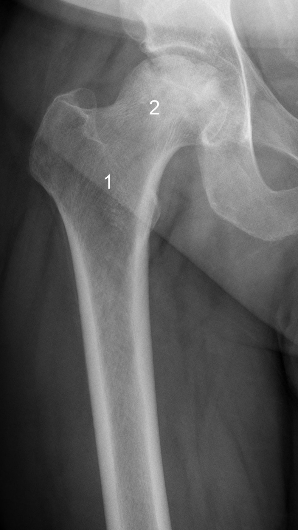 Fig. 1 
            Preoperative anteroposterior radiograph of a right hip in a 50-year-old man with osteonecrosis of the femoral head (ONFH). Trabecular bone explants were taken from the femoral head (1) and from the intertrochanteric region (2) of patients with ONFH.
          