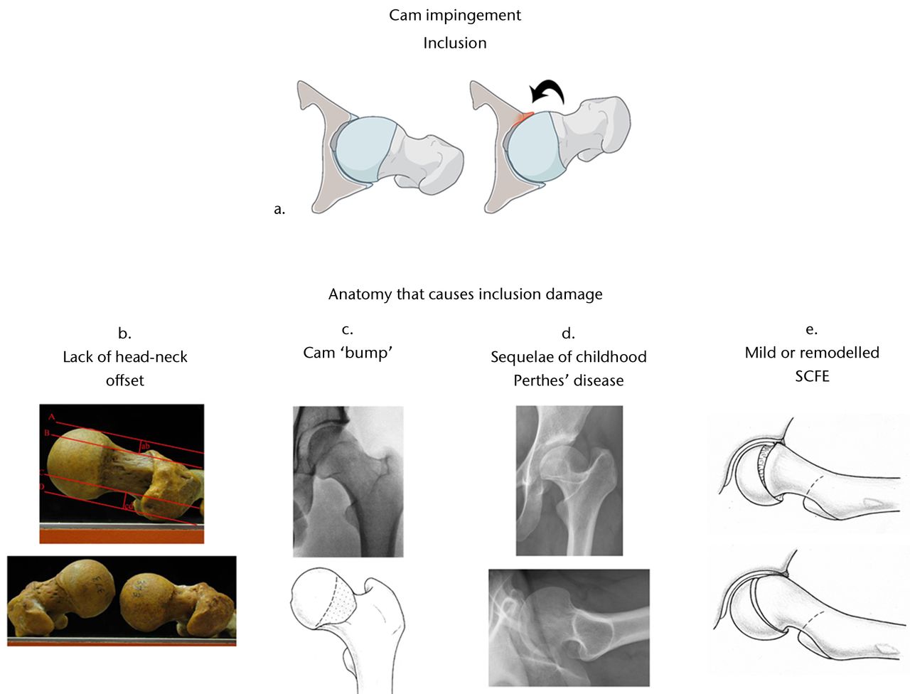 Fig. 1 
        Cam impingement creates an inclusion-type
of injury (a).25 A
bony deformity at the femoral head-neck junction enters the acetabulum
in hip flexion (curved arrow). This causes delamination of the cartilage
and separation at the chondrolabral junction. Many different types
of deformities can cause cam impingement, including a lack of femoral
head-neck offset (b),26 a
cam ‘bump’ (c),27 childhood
Perthes’ disease (d) and both mild and remodelled slipped capital
femoral epiphysis (SCFE) (e)12 (Reprinted
with permission: a) Leunig et al. Femoroacetabular
impingement: diagnosis and management, including open surgical technique. Oper
Tech Sports Med 2007;15:178–188. b) Toogood et al. Proximal
femoral anatomy in the normal human population. Clin Orthop
Relat Res 2009;467:876–885. c) Siebenrock et al. Abnormal
extension of the femoral head as a cause of cam impingement. Clin
Orthop Relat Res 2004;418:54–60. e) Leunig et al. Slipped
capital femoral epiphysis: early mechanical damage to the acetabular
cartilage by a prominent femoral metaphysis. Acta Orthop
Scand 2000;71:370–375).
      