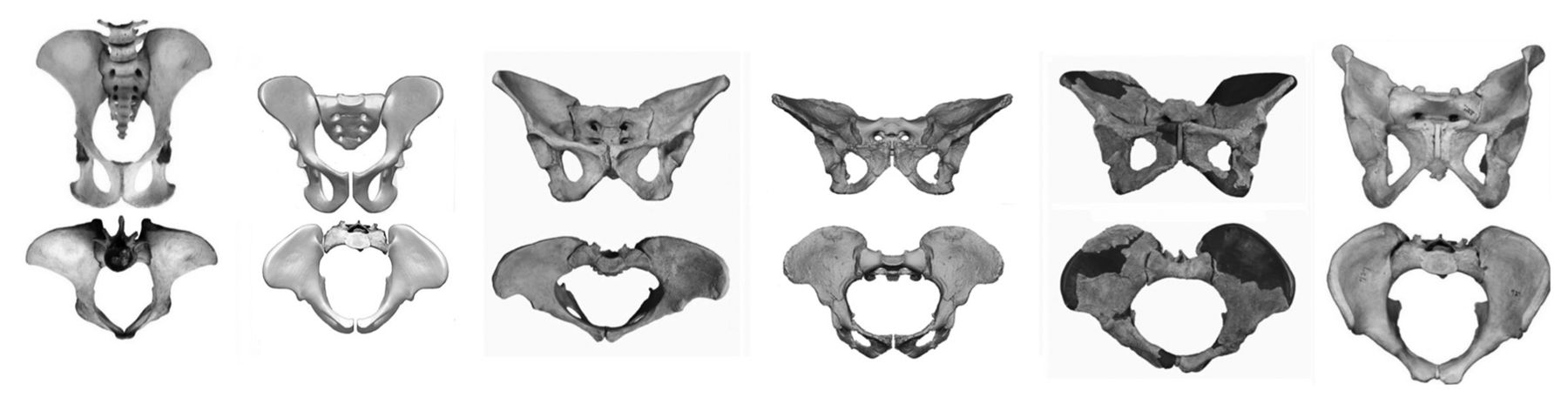 Fig. 4 
            Photographs and reconstructions showing
the evolution of the female pelvis, from the chimpanzee to man,
in anteroposterior (AP) (top row) and axial views (bottom row) From
left to right: chimpanzee, Ardipithecus ramidus (4.4
million years ago), Australopithecus afarensis (3.2
million years ago), Australopithecus africanus (2.7
million years ago), Homo erectus (1.5 million years
ago) and Homo sapiens. Scale is approximate. The
birth canal first widened transversely, but from Au. afarensis to H.
sapiens, the AP dimension deepened. (Reprinted with permission: Hogervorst
et al. Human hip impingement morphology: an evolutionary
explanation. J Bone Joint Surg [Br] 2011;93-B:769–776).
          