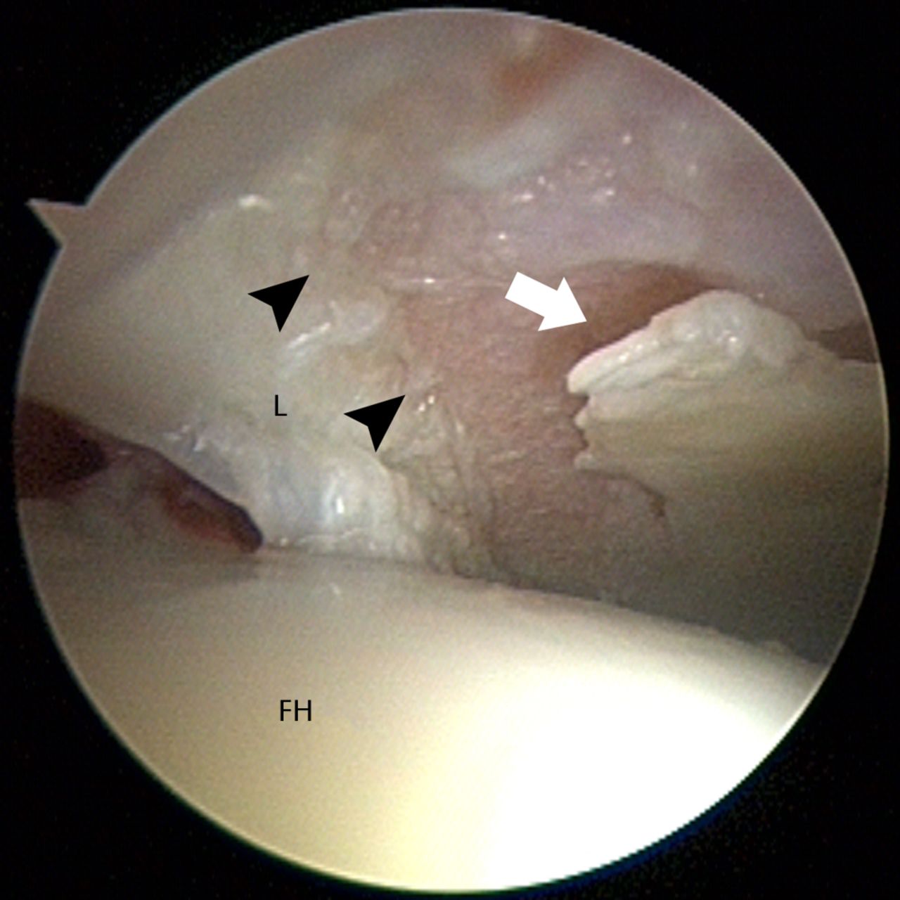Fig. 5 
            Arthroscopic image showing chondrolabral
damage occurring as a result of cam impingement. The deformity at
the head–neck junction causes a shearing, delamination injury to the
cartilage (white arrow) with tearing at the chondrolabral junction
(black arrowheads) (L, labrum; FH, femoral head).
          