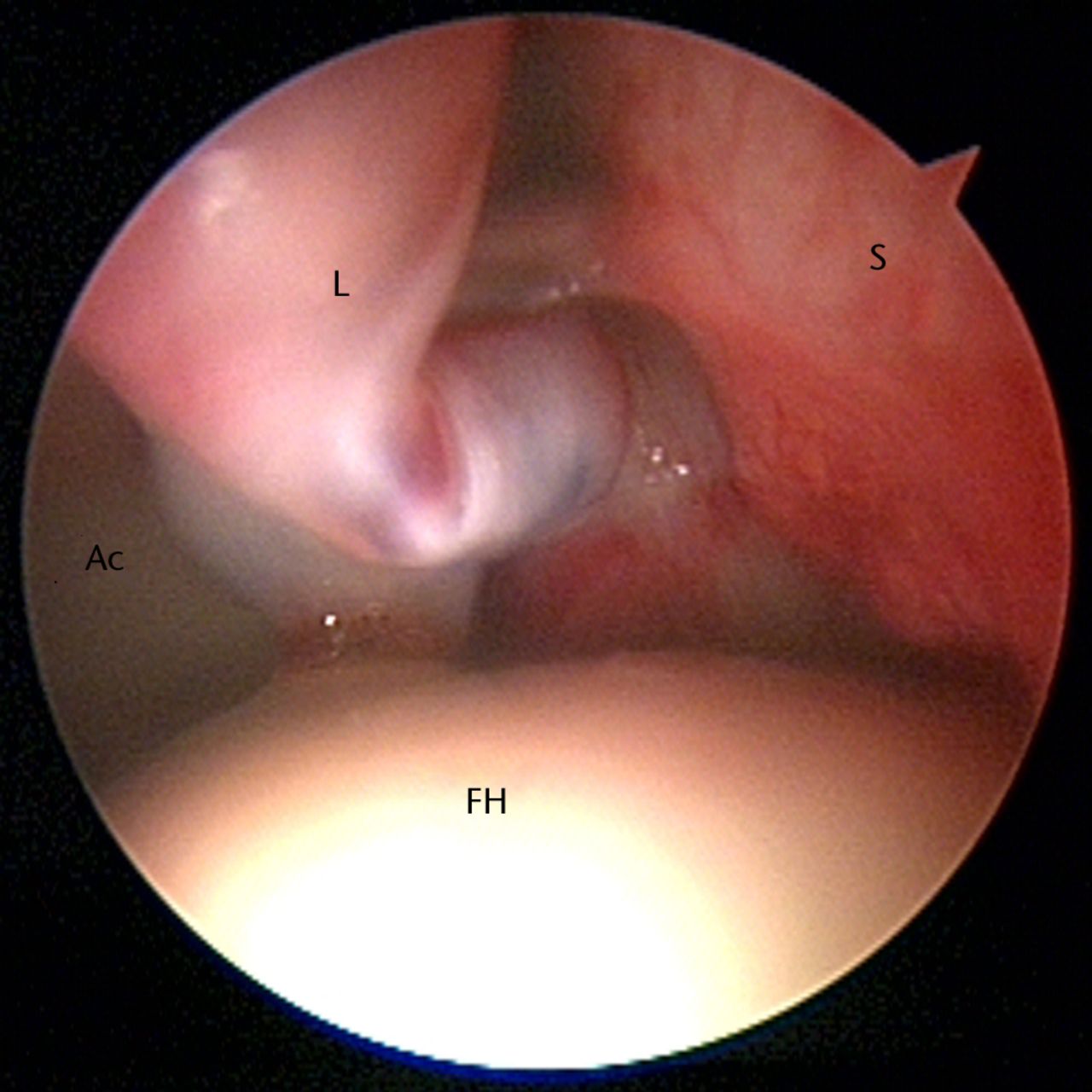 Fig. 6 
            Arthroscopic image showing chondrolabral
damage occurring as a result of pincer impingement. The labrum (L)
is bruised and hypertrophied, with adjacent synovitis (S). Cartilage
damage occurs on the femoral side in a linear wear pattern (FH,
femoral head; Ac, acetabulum).
          