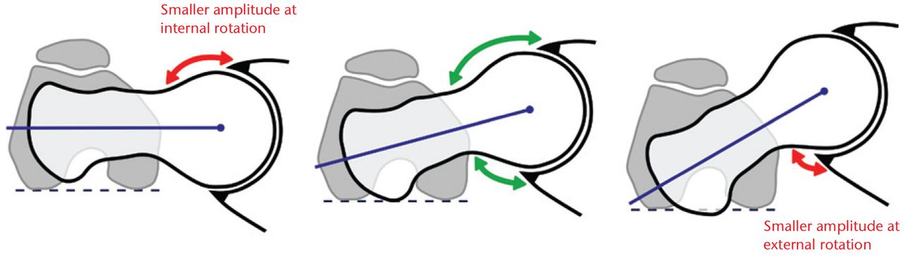 Fig. 8 
            Diagrams showing the proposed mechanism
of the effect of femoral version. In the retroverted femur (left),
the femoral head is already relatively rotated into the acetabulum,
which decreases the clearance of any head-neck abnormality in flexion
and exacerbates cam impingement. In an opposite manner, femoral
anteversion (right) may mitigate the effect of an anterior cam deformity
but could result in more impact on the posterior rim in external
rotation. (Reprinted with permission: Sutter et al. Femoral
antetorsion: comparing asymptomatic volunteers and patients with
femoroacetabular impingement. Radiology 2012;263:475–483).
          