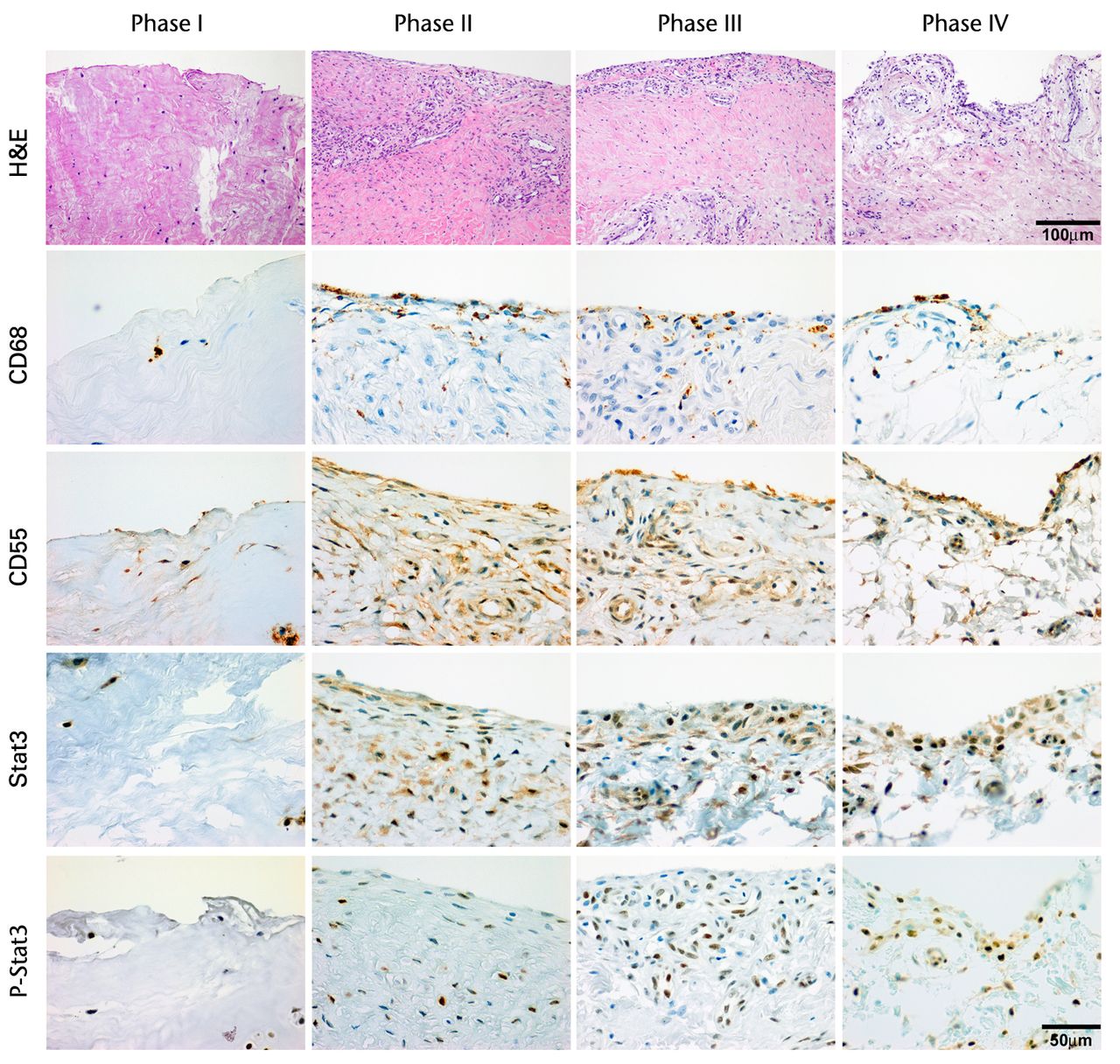 Figs. 2a - 2c 
            
              Figure 2a – haemotoxylin and
eosin staining (H &
 E) and cell distributions positive for CD68,
CD55, Stat3 and P-Stat3 of the ruptured end of the ligament in each
phase. Figures 2b and 2c – box plots showing quantification using
ImageJ software of b) the CD55 positive area and c) the P-Stat3
positive areas for the ruptured and mid areas of the ligament for
each phase. The box represents the median and interquartile range,
the whiskers the 10th and 90th percentiles and ° the outliers (*,
significant difference (p <
 0.01) compared with phases I and
II; **, significant difference compared with phases I, II and IV).
          