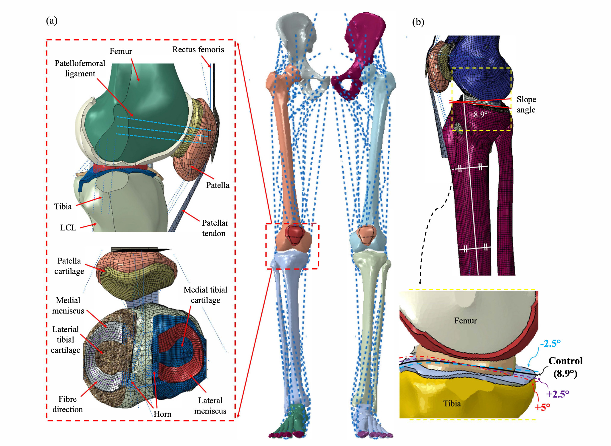 Fig. 1 
            a) Finite element musculoskeletal model with an intact knee. b) The original posterior tibial slope (PTS) angle was 8.9° and was defined as the standard angle. LCL, lateral collateral ligament.
          