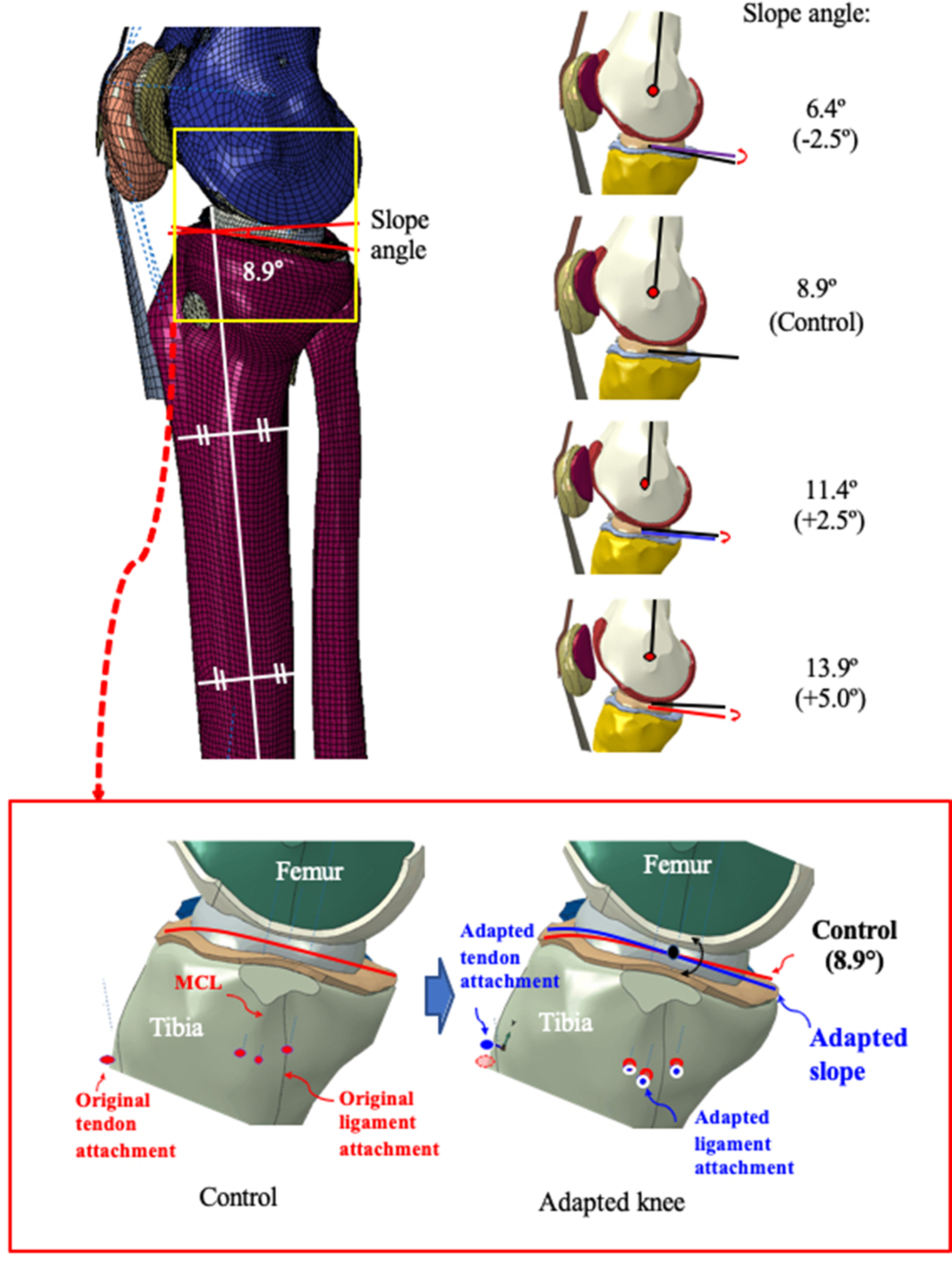 Fig. 2 
            Adapted knee model with different posterior tibial slope (PTS) angles in the tibial plateau. The muscle, ligament, and tendon attachments around the tibial plateau were correlately applied with modified PTS angles. MCL, medial cruciate ligament.
          
