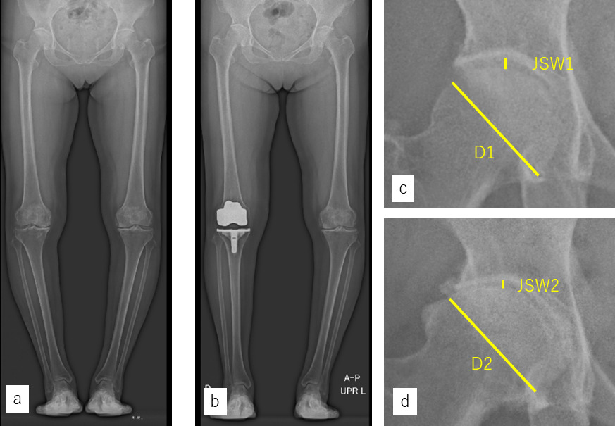 Fig. 2 
            Measurements of the hip joint space width in a representative case. A 65-year-old woman underwent total knee arthroplasty for osteoarthritis (OA) (bisphosphonate non-user). a) Anteroposterior standing whole-leg radiograph taken before surgery. b) Anteroposterior standing whole-leg radiograph taken at four years after surgery. c) Magnified image of the area including the right hip in panel a). d) Magnified image of the area including the right hip in panel b). The joint space width and the femoral head diameter were measured as indicated by the yellow lines. JSW1 and JSW2 are the joint space widths before surgery and at the final follow-up, respectively. D1 and D2 are the femoral head diameters measured on radiographs at three months after surgery and at the final follow-up, respectively.
          