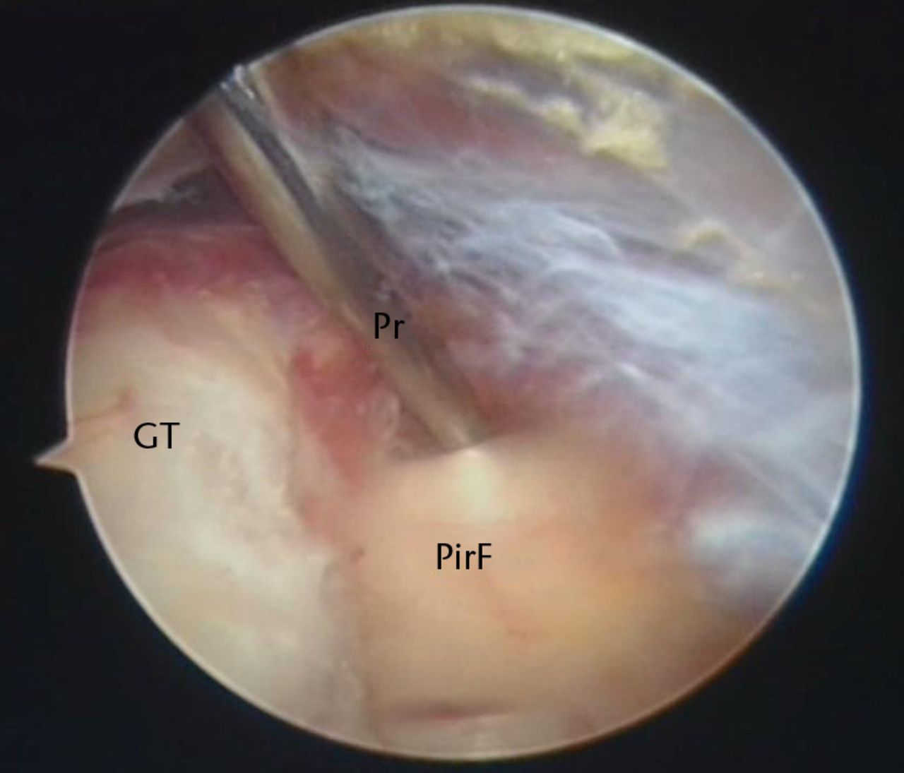 Figs. 3a - 3b 
          Endoscopic release of the piriformis
tendon and posterior hip capsule (GT, greater trochanter; Pr, endoscopic
probe; PirF, piriformis tendon; EcP, hooked coagulation probe).
        