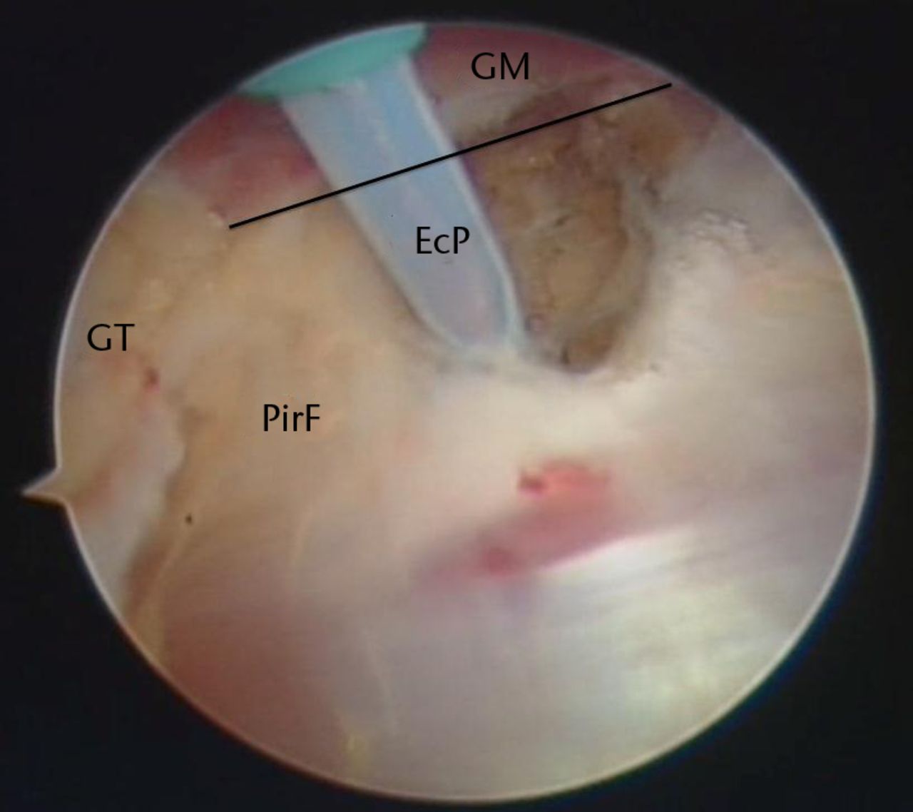 Figs. 3a - 3b 
          Endoscopic release of the piriformis
tendon and posterior hip capsule (GT, greater trochanter; Pr, endoscopic
probe; PirF, piriformis tendon; EcP, hooked coagulation probe).
        