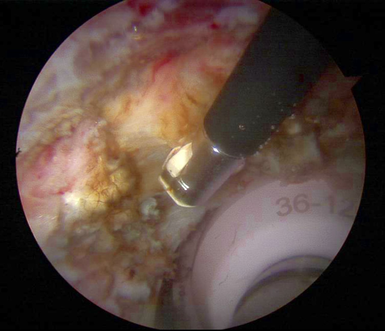 Figs. 4a - 4b 
          Arthroscopic psoas release for iliopsoas
impingement after a) total and b) resurfacing hip replacement.
        