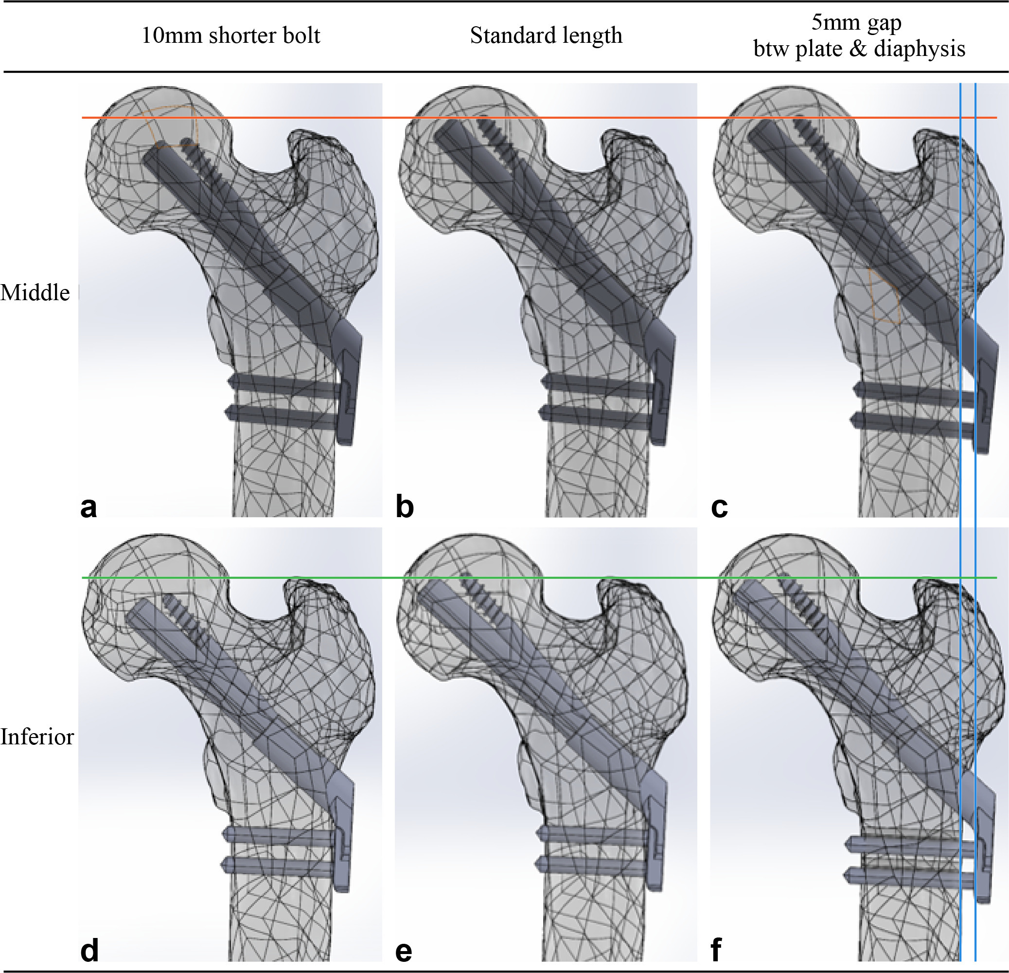 Fig. 1 
            Femur models with Pauwels III femur neck fracture were virtually fixed with the Femoral Neck System and were established with different combinations of surgical variations. a) to c) The bolt was placed in the central trajectory with respect to the neck cortical corridor in three models in the upper row, while d) to f) the bolt was placed in the inferior trajectory in three models in the lower row. The bolt measured 100 mm in length in the two models in the central column (b, e), which provides the shortest gap between the subchondral bone and implant tip without violating the articular surface. The length of bolts in the two models in the left column (a, d) was 10 mm shorter than the standard bolt. There was a gap between the plate and diaphysis and a 5 mm longer bolt to restore the position of the bolt tip in the two models in the right column (c, f).
          