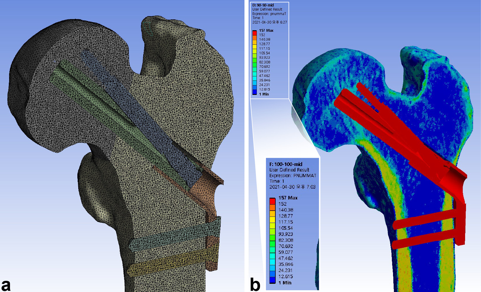 Fig. 2 
            Meshing of the elements and mapping of the material properties were performed after assembling the femur and implant models. a) The models were meshed into tetrahedral elements with a maximum size of 1 mm, achieving a mean of 6,177,864 nodes (6,172,059 to 6,186,454) and 4,487,265 elements (4,483,402 to 4,492,613). b) The material properties of bone were assigned to the elements using the mapping procedure based on the grey values of the CT scan.
          