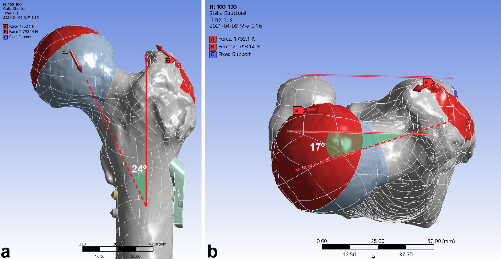 Fig. 3 
            The femur was loaded in the single-leg stance in each finite element model. a) A load vector of 1,752.2 N corresponds to 300% for a body weight of 59.6 kg. Abductor force was applied to the greater trochanter. b) The load vector (red dashed arrow) had an angle of 24° in the frontal plane and 17° in the axial plane. Weight load (green solid line) was transferred to the surface of hemisphere at an incline of 45° and retroversion of 25°.
          