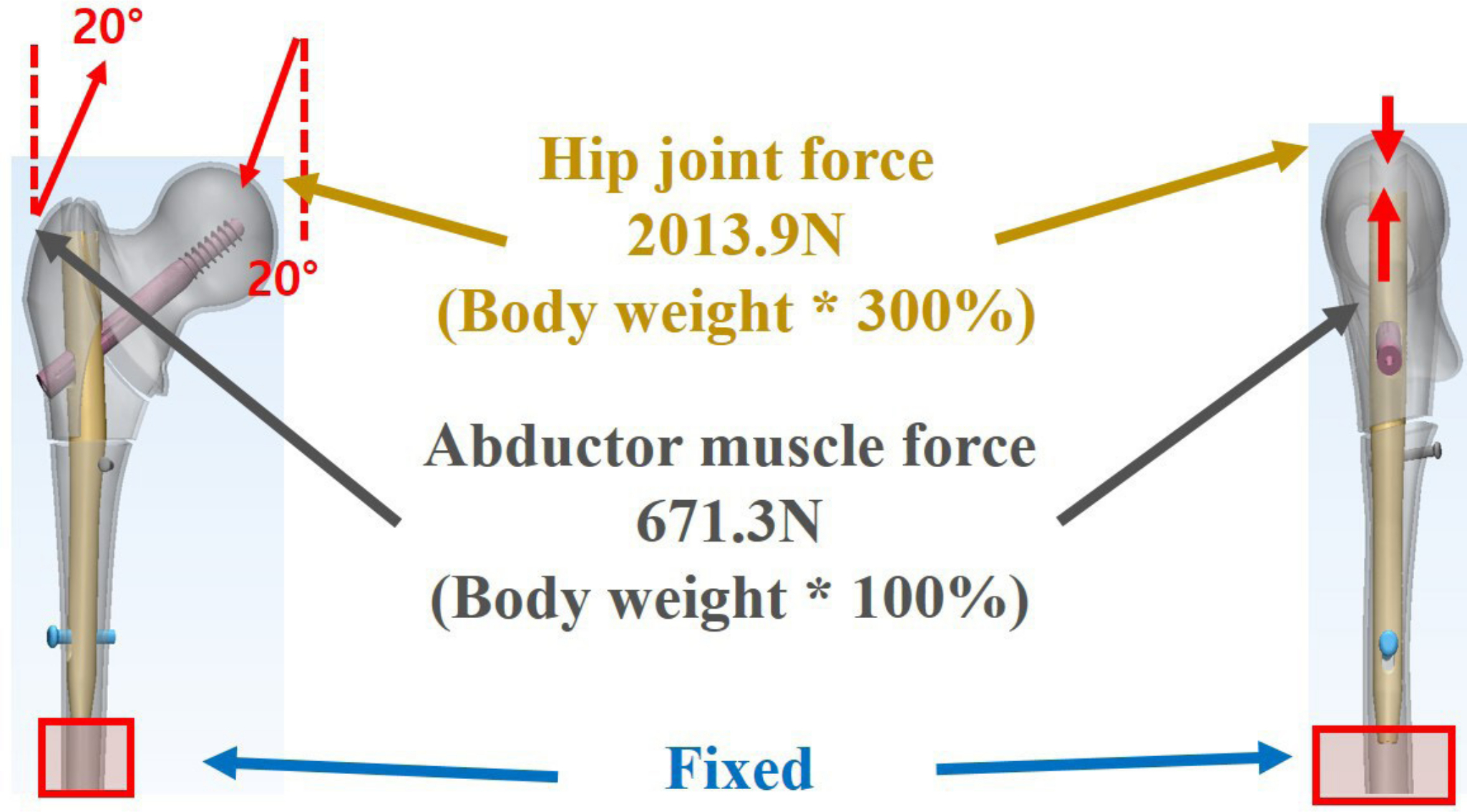 Fig. 2 
            Loading condition of the analysis model. Hip joint force, 2,013.9 N (body weight × 300%); abductor muscle force, 671.3 N (body weight × 100%).
          