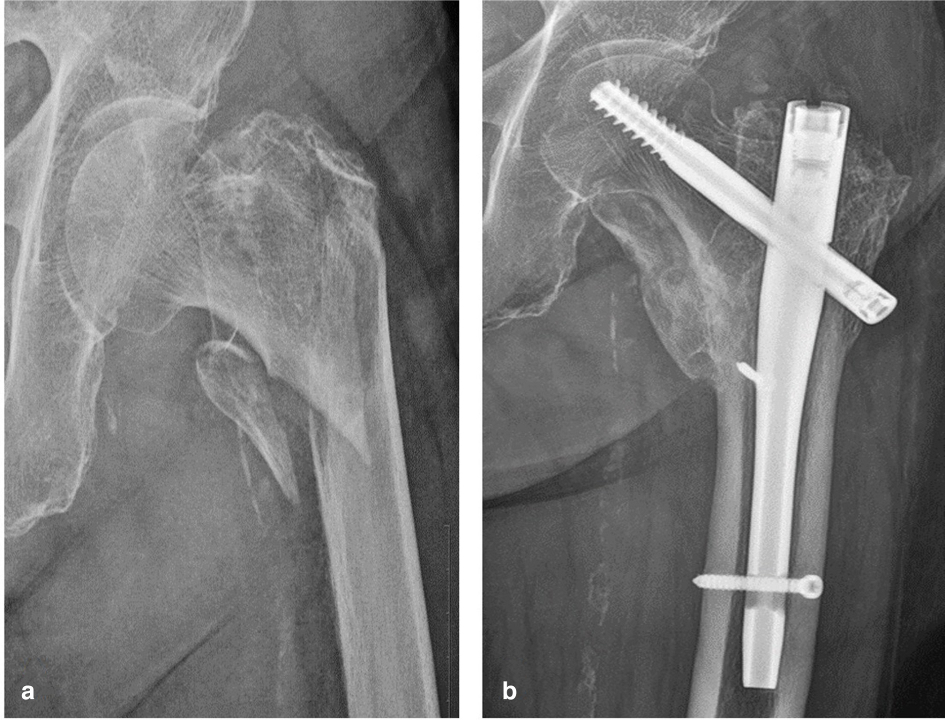 Fig. 9 
          Anteroposterior radiographs taken a) before and b) one year after surgery, showing complete bony union.
        