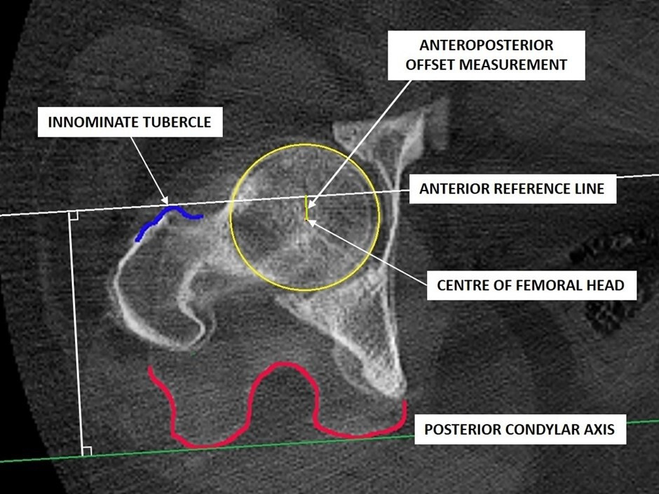 Fig. 1 
            Diagram highlighting the composite image constructed in order to measure the anteroposterior offset.
          