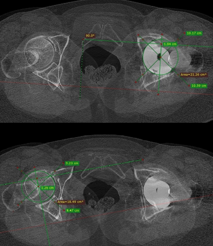 Fig. 2 
            Composite image imported into RadiAnt software demonstrating anteroposterior measurement on both the operated (1.94 cm) and non-operated (1.26 cm) sides.
          
