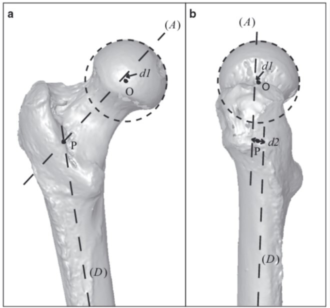 Fig. 6 
          Diagram demonstrating a) the position of the 3D axis of the femoral neck and the femoral shaft in a frontal view and b) a sagittal view. Distance (d2) demonstrates the offset between the two. Copyrighted image reproduced under permission from John Wiley & Sons, Inc.
        