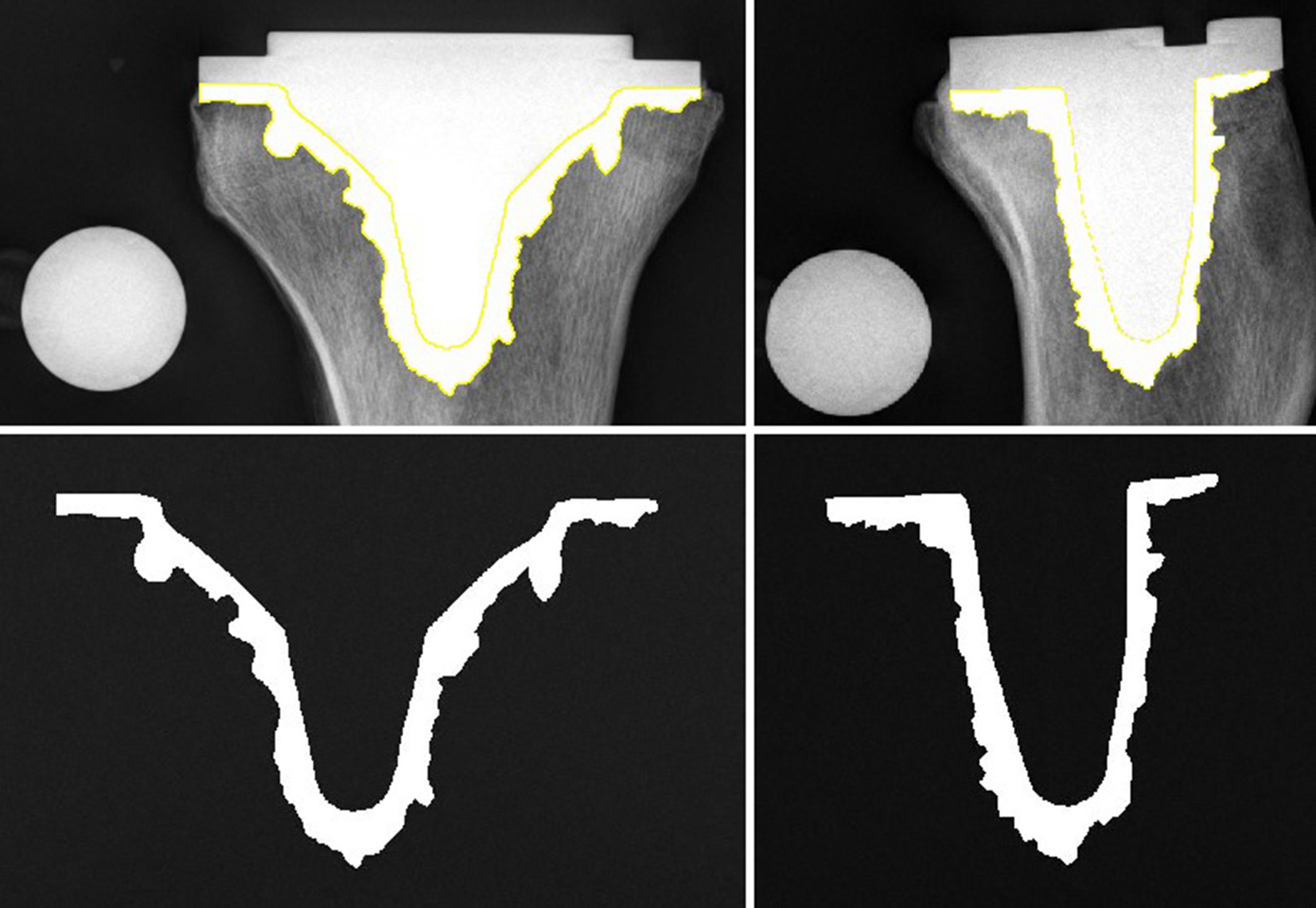 Fig. 5 
            2D X-ray analysis: cement penetration area in anteroposterior (left) and lateral direction (right).
          