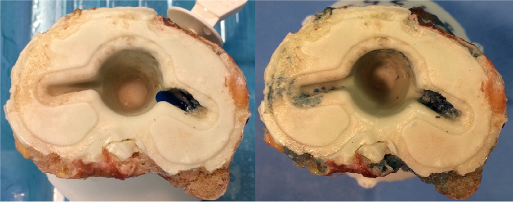 Fig. 7 
            For validation of the cement defects (using CT scans), and to check whether there was a direct connection between the medullary canal and the tibial component, 0.9% saline solution with blue pigments was injected into the medullary canal distally of the prosthesis tip.
          