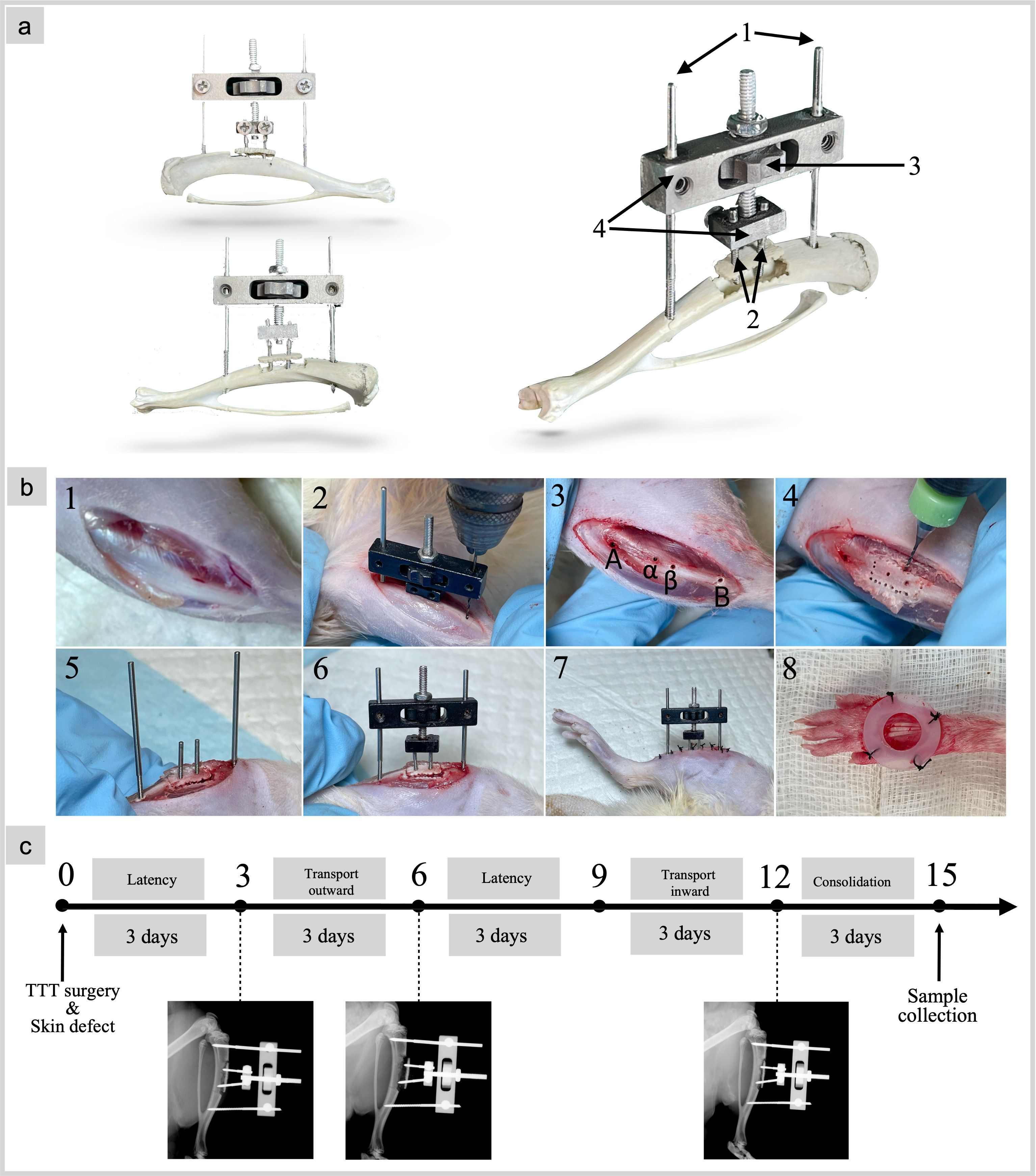 Fig. 1 
            Introduction of tibial cortex transverse transport (TTT) external fixator, surgical procedure and workflow. a) Components of TTT external fixator: 1) two long screws; 2) two small screws; 3) a turning nut; and 4) the external fixator frame. b) Surgical procedure of TTT technique and skin defect: 1) The right tibia was exposed; 2) and 3) guided with the external fixator, holes A, B, α, and β were drilled; 4) pinholes were drilled around holes α and β, forming a bone window; 5) four screws were inserted; 6) and 7) the cortical bone chip was dislocated, and the external fixator was assembled and incision sutured; and 8) a silicone splint was fixed to the wound skin. c) Workflow of TTT application. A radiograph was taken to track the cortical bone chip status.
          
