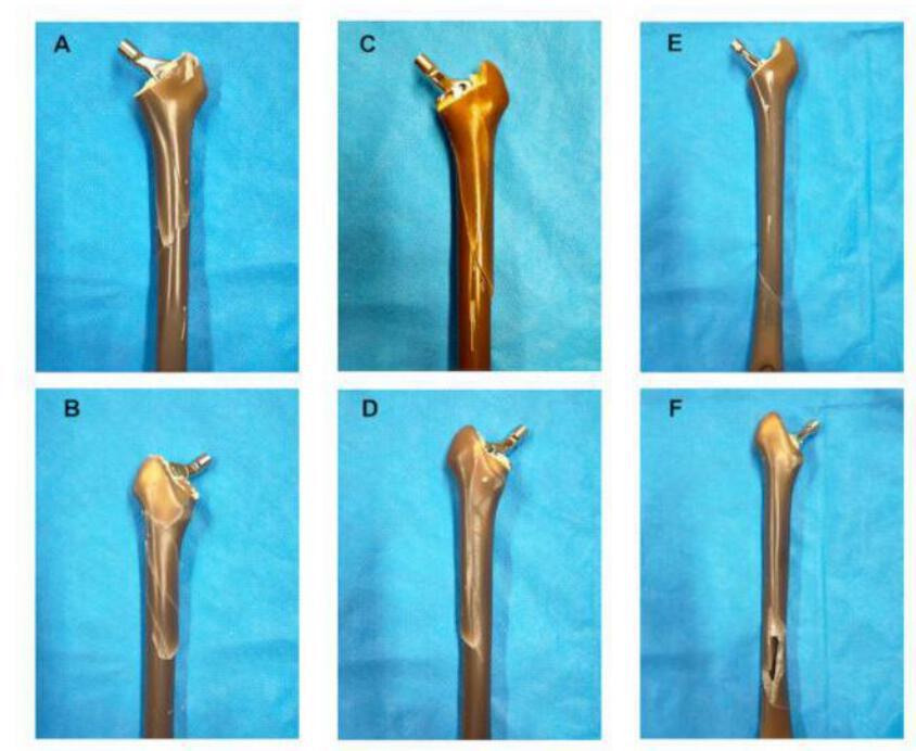 Fig. 5 
            Examples of the fracture pattern of each stem created by our testing mechanism. a) and b) Collarless polished tapered stem: a) anterior side, b) posterior side. c) and d) Versys stem: c) anterior side, d) posterior side. e) and f) Charnley-Marcel-Kerboull stem: e) anterior side, f) posterior side.
          
