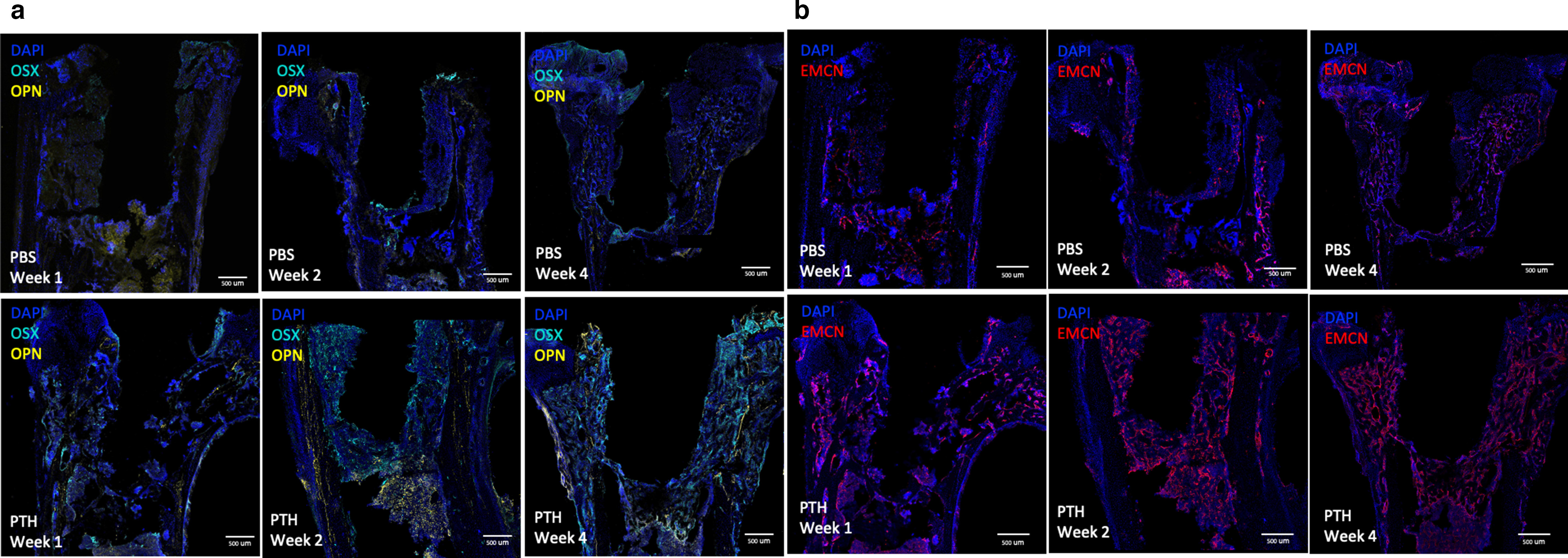 Fig. 4 
          Immunofluorescence staining of phosphate buffered saline (PBS)-control and intermittent parathyroid hormone (iPTH) treatment. a) Minimal progression of peri-implant bone formation is present in the PBS-control group, whereas after two weeks and four weeks of iPTH treatment increases in osterix (OSX), osteopontin (OPN) at distal pedestal region, and b) endomucin (EMCN) expression are detected, indicating angiogenesis around the implant with osseointegration. Scale bars = 500 µm. DAPI, 4,6-diamidino-2-phenylindole.
        