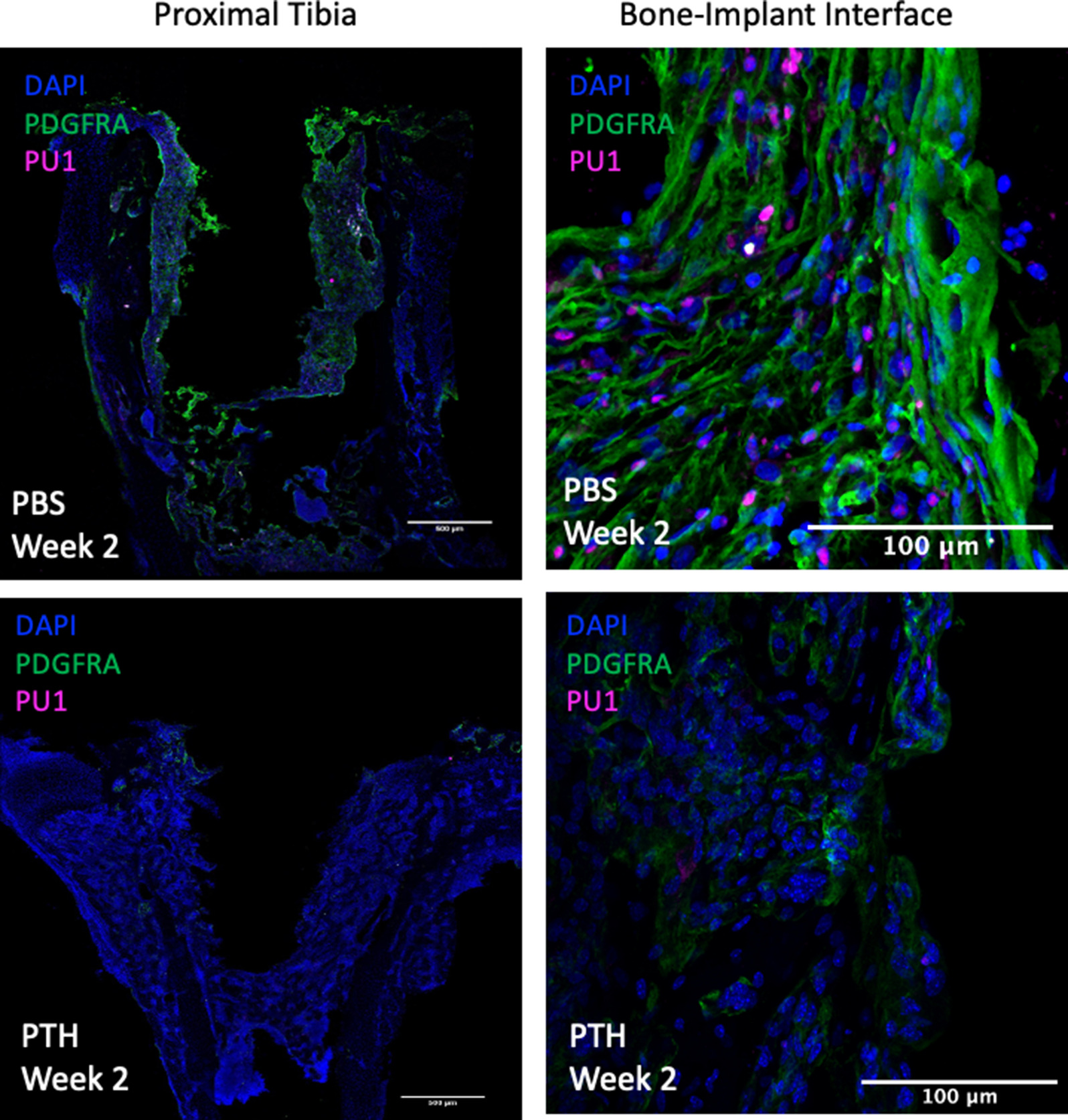 Fig. 5 
          Membrane formation visualized through immunofluorescence staining with platelet-derived growth factor receptor α (PDGFRa) and PU.1 labelling. The intermittent parathyroid hormone (iPTH)-treated group displays a distinct decrease in PDGFRa and PU.1 signal, indicating a reduction of fibrous tissue formation around the implant. Scale bars: 500 µm (left panel) and 100 µm (right panel). DAPI, 4,6-diamidino-2-phenylindole.
        